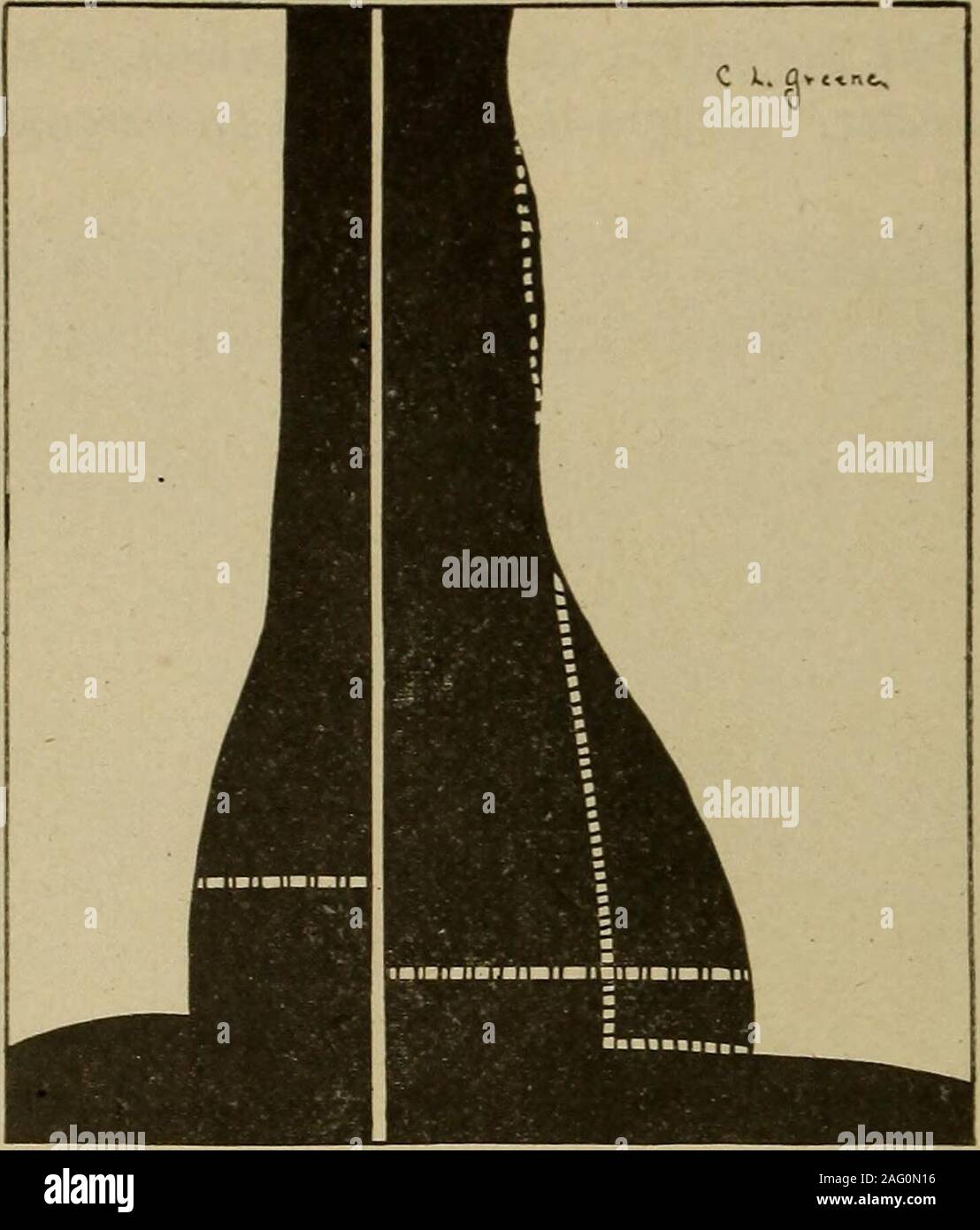 . Medizinische Diagnose für Studenten und Praktiker. Abb. 299.- Eine extreme Instanz der Tropfen Herz (dorso-ventrale Aspekt). Abmessungen: Herr, 2 cm.; Ml., 5,5 cm.; total Quer, 7,5 cm. (Gleiche Herz in Abb. 1 gezeigt. 158.) so genannte passive neurasthenie, und die physischen und mentalen characteristicsof diese Patienten, als die von ihm beschrieben, scheint man bei replacinghis Zeichen der unbekannte Menge durch den Begriff der chronischen kongenitalen Asthenie zu rechtfertigen. Diese, den verfassungsrechtlichen Mangel der Struktur und der Funktion von denen BertholdStiller, von Budapest, gezeichnet hat, so klar und lebendig wie zu sichern, was Stockfoto