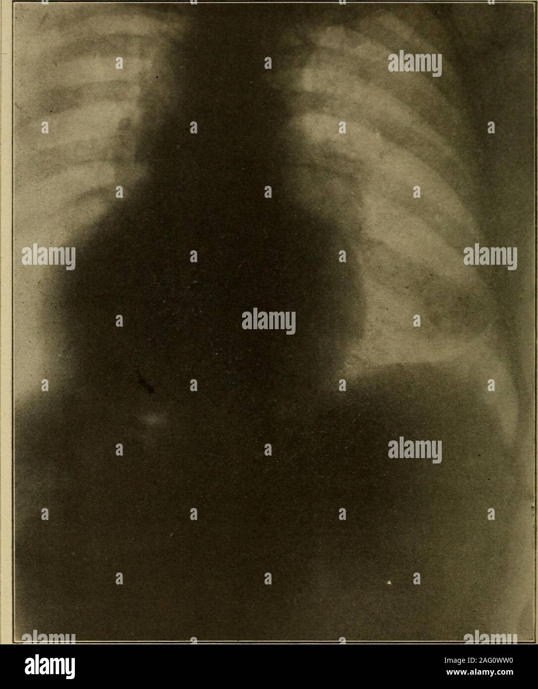 . Medizinische Diagnose für Studenten und Praktiker. Abb. 292,- Aortenstenose Art der kardialen skizzieren. Hinweis Kontur des linken Ventrikels likean Ei auf seiner Seite. Dorso-ventrale Aspekt. (Dr. Frank S. Bissell.) Ursache so dicht ein Schatten in der linken phrenic - rippenbögen Winkel als tatsächlich an simulatea pleural Exsudat oder erschweren die Abgrenzung des wahren Linken ventricularborder, es sei denn, die klärende Wirkung der tiefen gezwungen Inspiration hervorgerufen wird. In einem solchen Herzen die Diaphragmatica Bewegungen eingeschränkt sind und dass Struc-A misleadingshadow. 58 o medizinische Diagnose Epigastricoppression. ture selbst kann vorab Stockfoto