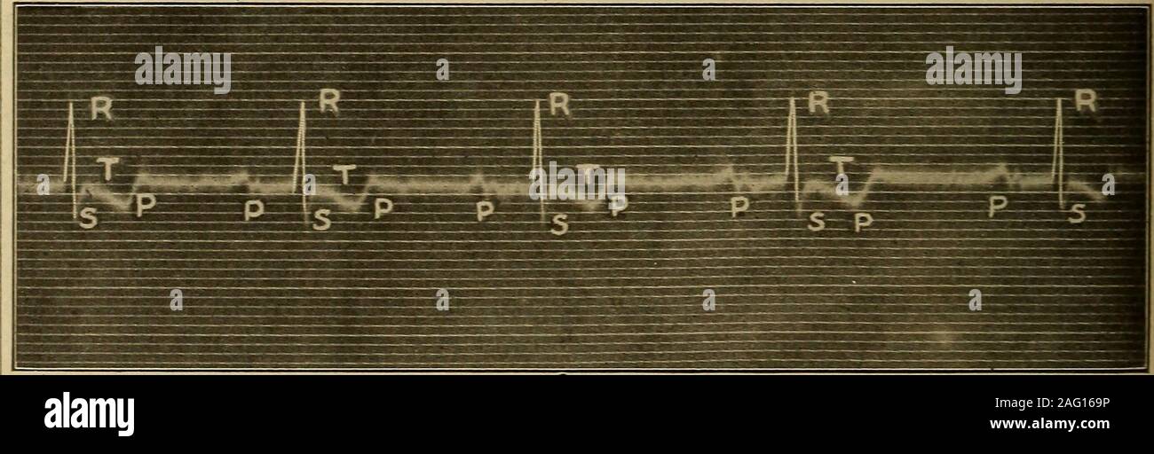 . Medizinische Diagnose für die Studierenden und Praktiker. sympathisch, direkte vagus Druck von Vergiftungen durch Adrenalin, Digitalis, oder führen, oder in Verbindung mit intrakranieller Druck, akute Infektionen, Asphyxie, Ikterus, rekonvaleszenz von akuten Infektionen, profunde Toxemias, arterielle K R U P1-P3-I-l&gt; j | ein Efc 1 JSl.lu u Abb. 273,- Kompletter Herzblock. Hinweis Ordnungsmäßigkeit der Congelador und ventrikuläre Kom-plexe und völlig unabhängige Rhythmus. P6 hat genau auf eine ventrikuläre T. (nach Thos gefallen. Lewis.) Ableitung II. Abb. 274.-Digitalis Herz Block (teilweise). Invertiertes T und l Stockfoto