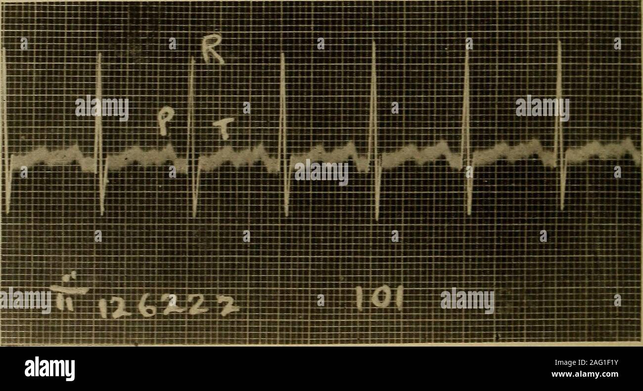 . Medizinische Diagnose für Studenten und Praktiker. Dieser Zustand wird durch eine suddenoutburst der schnellen Aktion von ganzem Herzen und die abrupte Beendigung nach Aperiod in Minuten, Stunden oder Tagen Dauer gekennzeichnet. Es ist in der Regel, wenn nicht immer, von extrasystolen von Congelador Herkunft initiiert. Selten ist es sagte Ven - tricular Ursprungs. (Siehe Seite 559.) Besondere Bedingungen. - Die infantile Art der Herzen ist ein zentral gelegenes, tief liegende Herz. Die EKG-Aufzeichnung ist in diesen Fällen sagte zu becharacterized durch eine Minute erste Leitung, die anderen zwei Leitungen des usualheight. Herzen hav Stockfoto