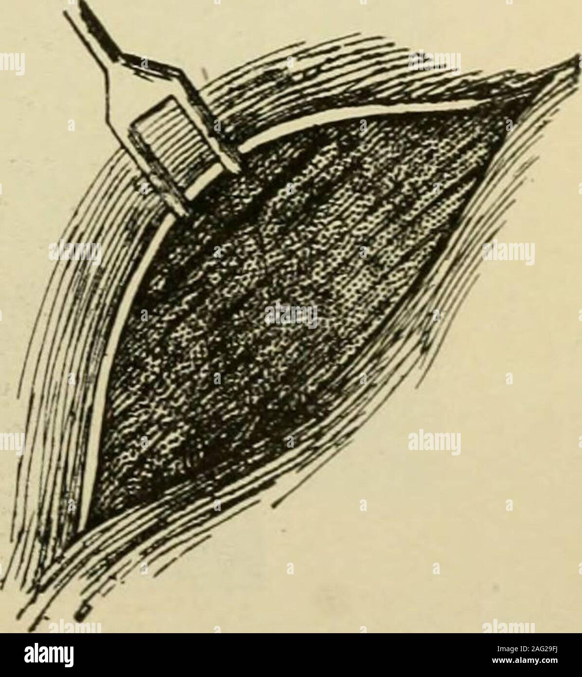 . Handbuch der operativen Chirurgie. -^ Zoll unter theHarrison Crippsline des Einschnitts (Seite 454). Pullthe superior Kanten der Hautschnitt nach oben Soas der tiefen Strukturen der Bauch-wallat der Harrison Cripps line (Abb. freizulegen. 613). Teilen thedeep Strukturen entlang dieser Linie und so öffnen Sie den Bauch. Schritt 2.- ^ Ziehen Sie die sigmoid Biegung aus der Wunde; alle überschüssigen ofsigmoid Push up in den Bauch, so dass so wenig Darm ist unterhalb der Ausgeweideten loopas möglich, d. h. Links, die Teil der Darm, vereint mit dem Bauch-Wall ist gewählt aslow der Darm wie möglich ist. Durch dieses Mittel eine fäkale re Stockfoto