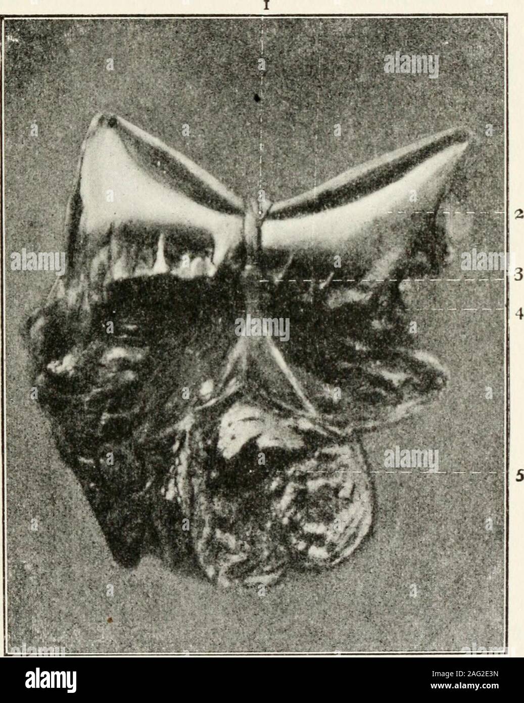 . Elementare Vorträge zu Tiermedizin, für landwirtschaftliche Studenten, Bauern und Lagerhaltern... Abb. 7.-Tuberkulösen Mesenterium von Pferd. I. Teil des Dünndarms. 2, 2. Mesenterium. 3, 3, 3. Tuberkulösen Einlagen. (Abrollen von 8 bis 10 Zoll dreh Tabak, und in eine Quart ofboiling Wasser, Belastung, und wenn so warm wie neue Milch - ^.^., 98° bis 100 °F - Geben als Einlauf.) Wenn dies nicht geben Relief veterinaryaid sollten auf einmal geladen werden, wenn der Darm mayhave zu durchstoßen werden, damit das Gas entweichen, die im Absatz 242. Manchmal 2 Unzen Natron in einem Pint ... Stockfoto