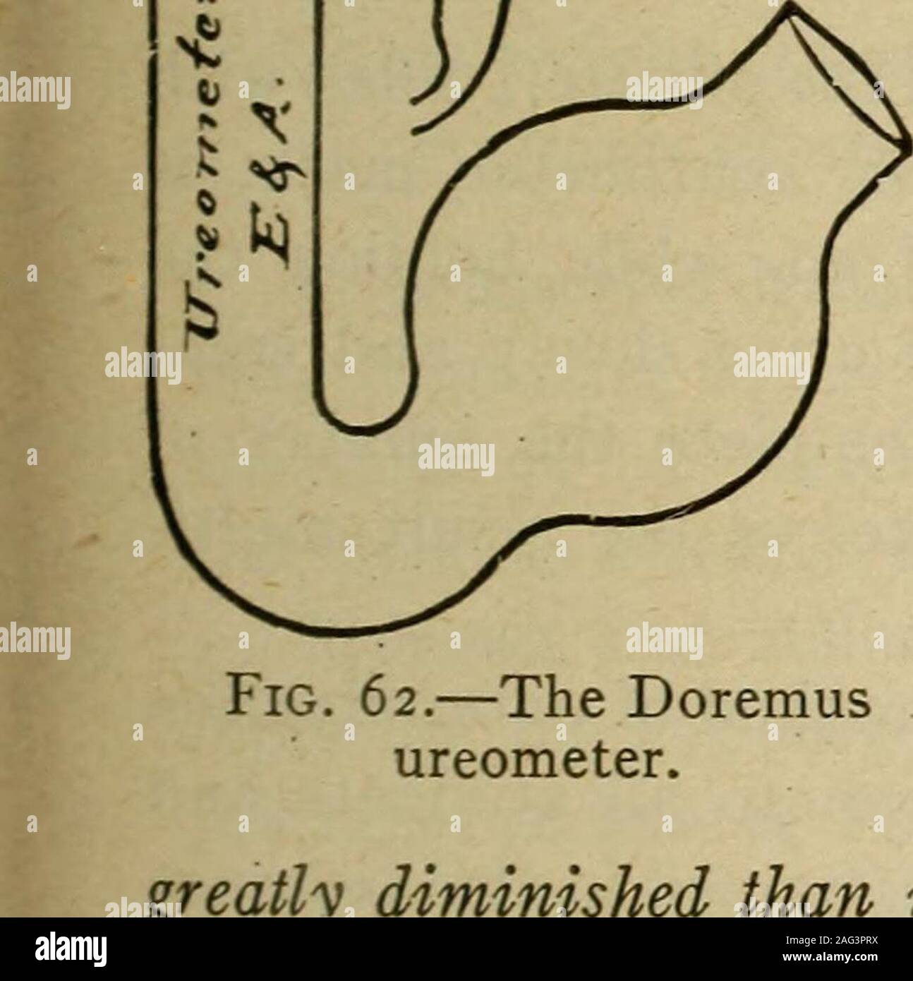 . Medizinische Diagnose für die Studierenden und Praktiker. rea Ausscheidung ist in vielen Bedingungen verbundenen withmarked Gewebe Abfälle wie Fieber, schweren greatlyincreased Ad-fortschrittliche Diabetes, perniziöse Anämie und Leukämie. Bei Erkrankungen der Leber, durch die die Harnstoff ausgeschieden, moregreatly zurückgingen als ist die Gesamtmenge an Stickstoff, Leucin und Tyrosin, coinci - dank der erhöhten, oder, in akuten Prozesse, eine erhöhte Ammoniak excretionreplaces der Leucin und Tyrosin. In Anbetracht der jüngsten Arbeit der Folin und andere, man kann themere Schätzung von Harnstoff als Ersatz für die Gesamtmenge an Stickstoff, die Bestimmungen berücksichtigen Untersuchung Stockfoto