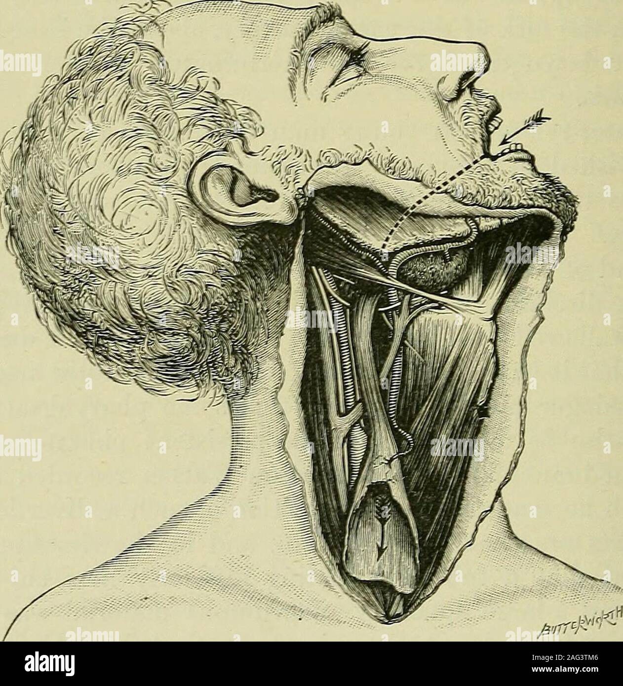 . Tumoren, unschuldig und bösartigen; ihre klinische Zeichen und die entsprechende Behandlung. ^ eingeführt werden, an der lowera Bleistift könnte ohne weiteres in das Lumen der Tube weitergegeben werden. Es ist weiter bemerkenswert, dass die Pharyngeal Drossel wassituated zwischen Unterkiefer und die Stylo-hyoid Ligament. Ausgangspunkt aus dem Schlund entspricht Fossa zu thesupratonsillar. Der Muskel-Fasern, für die mostpart, Rot-gestreift, und das schleimige Futter ähnelte der ffisophagus Steuerung gespeichertenfahrzeugtyp. Es hat lange Zeit der Verdacht gehegt worden war, daß die sogenannte Talgdrüsen. Abb. 246.-divertikel. {Nach Morrison W Stockfoto