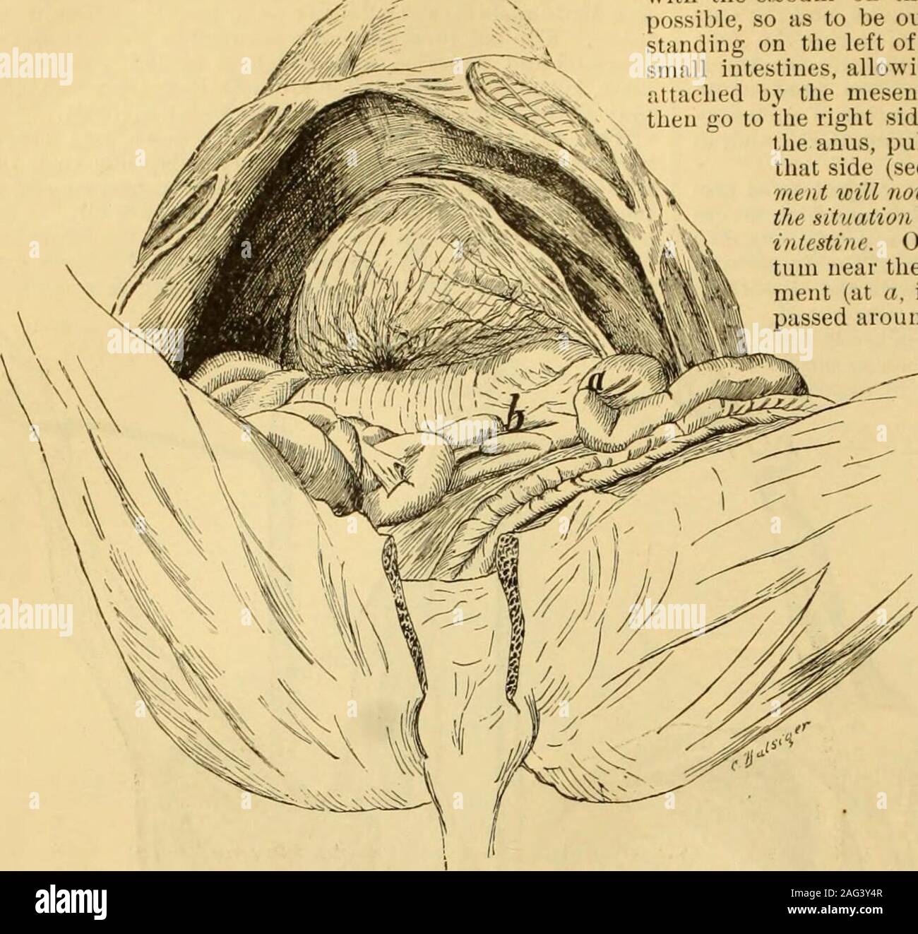 . Eine Referenz Handbuch der medizinischen Wissenschaften: umfassen das gesamte Spektrum der wissenschaftlichen und praktischen Medizin und verwandter Wissenschaften. anormale Betriebsbedingungen theperitoneum. Wir sind jetzt bereit, die dissectionof den Darm zu beginnen. Für die Bequemlichkeit der Beschreibung der Bauchhöhle Zentrum von Pouparts ligament auf beiden Seiten. Die regionsthus gebildet werden, zwischen der Membran und die trans-vers Ebene durch den fünfzehnten Rippe, die lefthypochondriac, Epigastrischen und rechts Hypochonder; inder Region zwischen der Ebene und der transverseplane, die durch den Winkel der Il Stockfoto