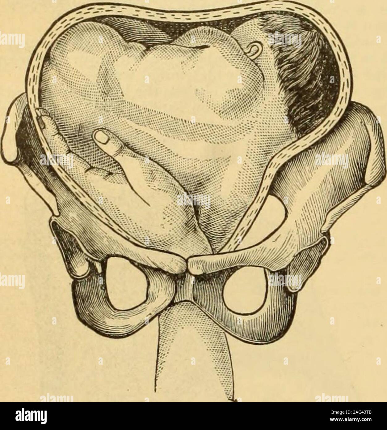 . Eine Referenz Handbuch der medizinischen Wissenschaften: umfassen das gesamte Spektrum der wissenschaftlichen und praktischen Medizin und verwandter Wissenschaften. zum Rand in einer schrägen Durchmesser; aber, als Es forcedfarther down ist, die Schulter nach vorne gedreht und werden - kommt es fixiert, während die Thorax und Abdomen areemu. in den hinteren Teil des Beckens durch flexionupon selbst (Bild geführt. 4565). Nun, so lange die stellungentspricht immer noch schräg, und wenn Flexion des Rumpfes hat noch nicht begonnen, ich er Teil kann leicht durch Druck uponthe Schulter in der Achse des Superior Strait angehoben werden; aber sosoon als Shou Stockfoto