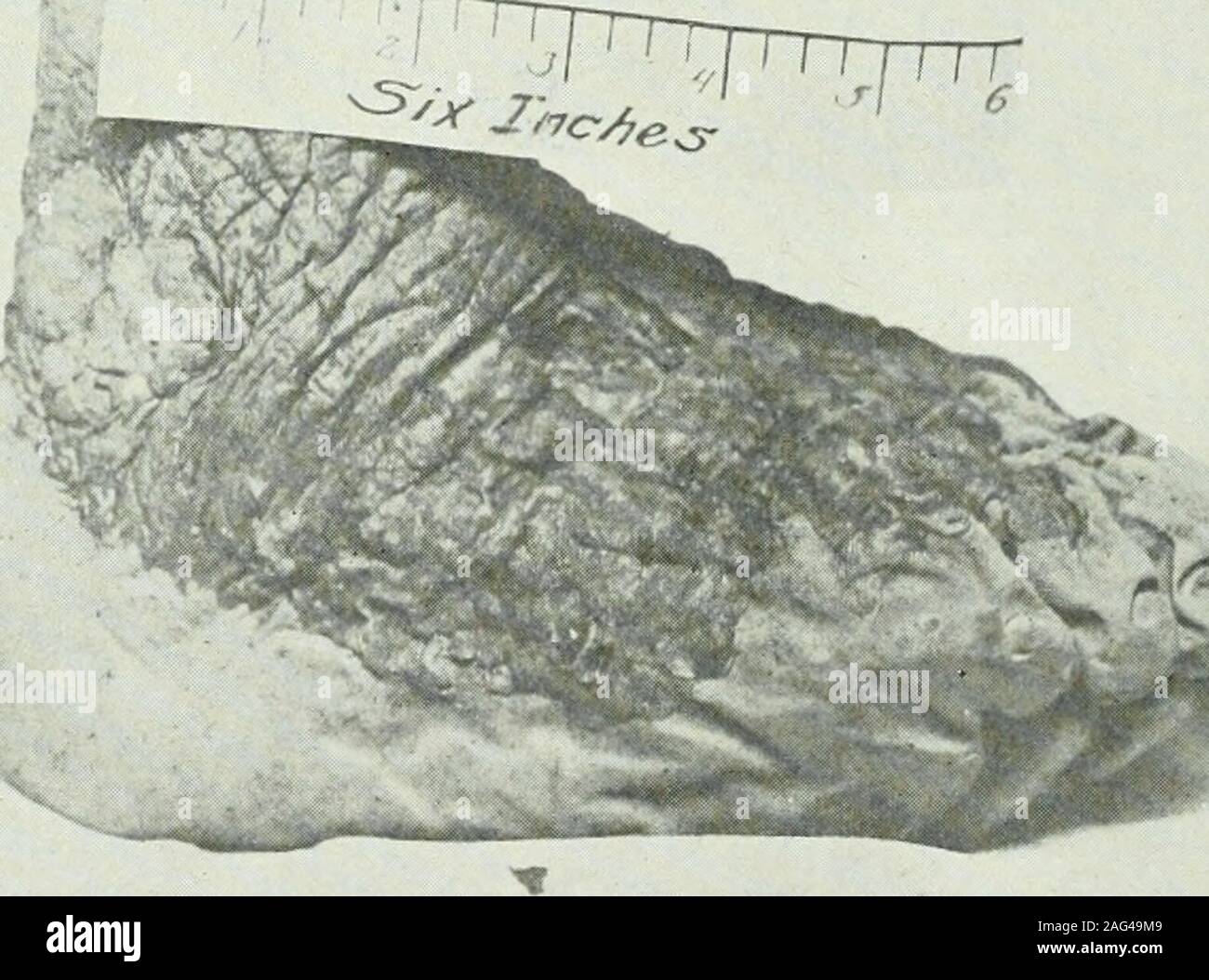 . Die amerikanische Zeitschrift für tropische Medizin. s sind nicht beteiligt. Plantar: In der Mitte der Sohle ist ein heraus gequetscht Sinus openingabout 8 mm im Durchmesser. Es gibt vier weitere, weit voneinander getrennt, anterior zu dieser, über die Kugel und auf der externen Seite, in der Nähe der ballis eine Gruppe von drei kleinen gelben Knötchen, dass abgeflacht worden,,die von 3 bis 5 mm im Durchmesser. Diese sind stark von der normalen circumscribedand Epidermis getrennt. Dies sind die einzigen lesionson der Sohle. Interne Änderungen: Die Probe wurde durch einen einzigen longitudinalincision geöffnet, Beginn zwischen der zweiten und dritten Zehe Stockfoto