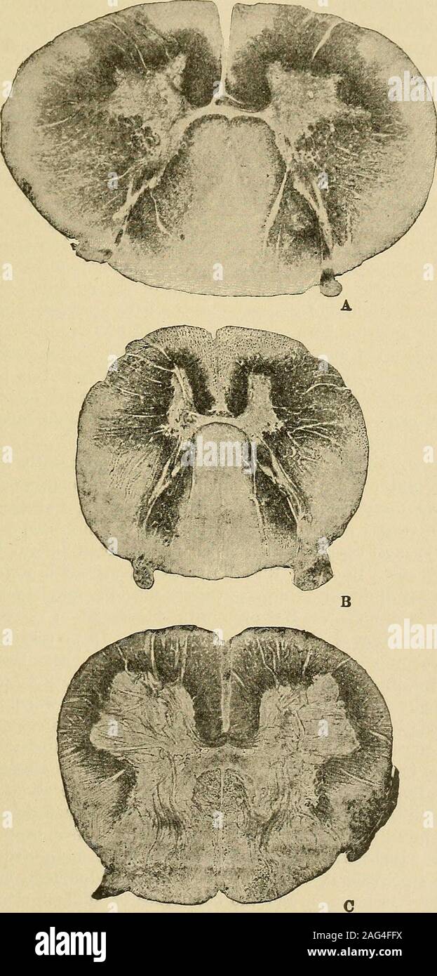 . Ein Handbuch von Krankheiten des Nervensystems. onecase Neugierig rhythmischen Bewegungen am Handgelenk und Ellenbogen wurden gesendet, was diejenigen von canine Chorea, und wahrscheinlich von Bedeutung, wie wir sehen werden, wenn wir kommen, die krankhafte Anatomie zu diskutieren. Con-tractions kann Superadded, Wundliegen, Blasenentzündung und gradualexhaustion führen früher oder später zu einem schwerwiegenden Problem. Neben der Symptome aufgezählt gibt es natürlich die usualsymptoms tiefer Anämie - wie die Verringerung der Zahl der Blutkörperchen haemoglobinand, Vergrößerung von Milz und Blutungen inder Retinae und anderswo. Aber, wie bereits Stockfoto . Ein Handbuch von Krankheiten des Nervensystems. onecase Neugierig rhythmischen Bewegungen am Handgelenk und Ellenbogen wurden gesendet, was diejenigen von canine Chorea, und wahrscheinlich von Bedeutung, wie wir sehen werden, wenn wir kommen, die krankhafte Anatomie zu diskutieren. Con-tractions kann Superadded, Wundliegen, Blasenentzündung und gradualexhaustion führen früher oder später zu einem schwerwiegenden Problem. Neben der Symptome aufgezählt gibt es natürlich die usualsymptoms tiefer Anämie - wie die Verringerung der Zahl der Blutkörperchen haemoglobinand, Vergrößerung von Milz und Blutungen inder Retinae und anderswo. Aber, wie bereits Stockfoto