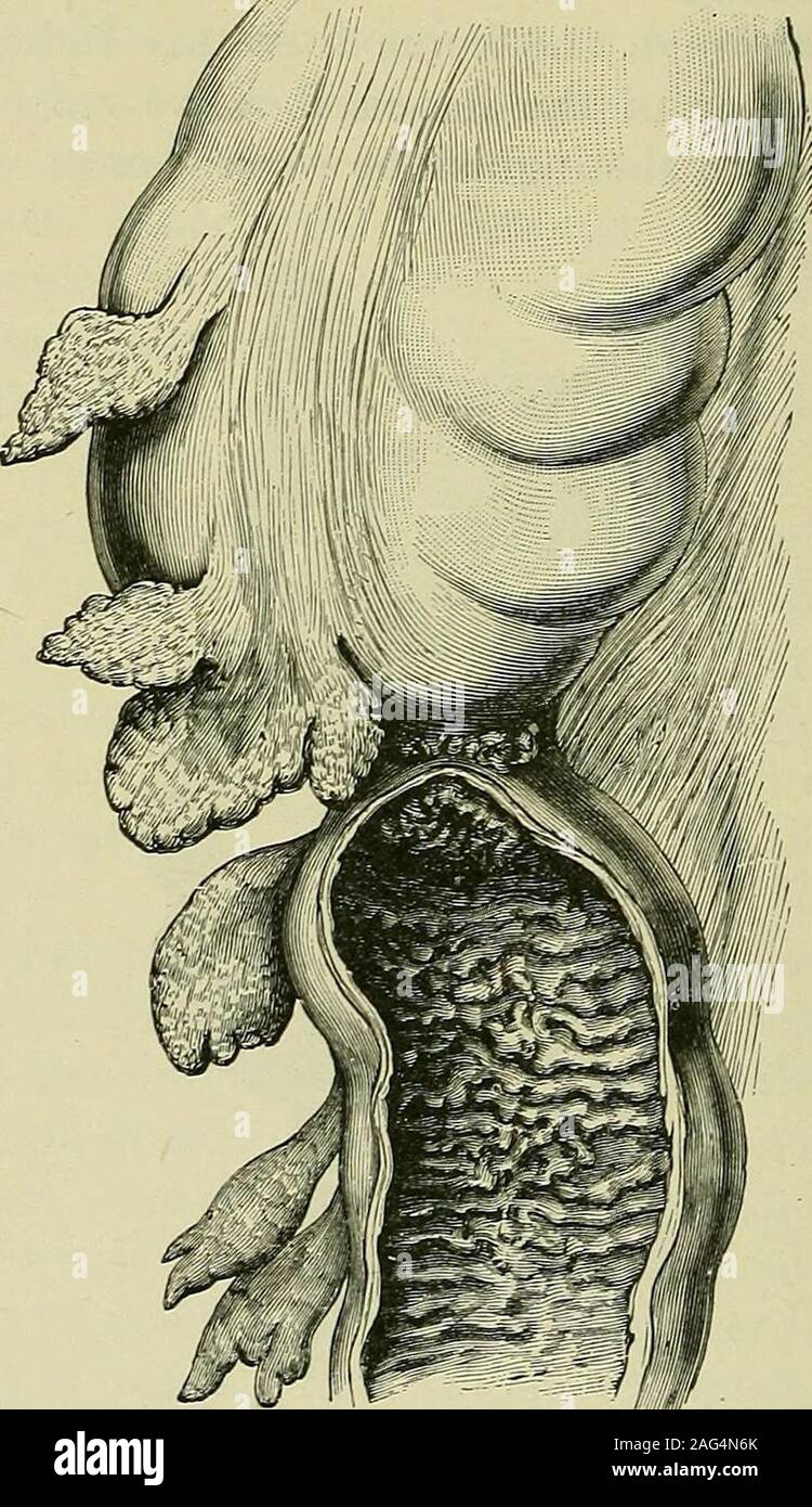 . Tumoren, unschuldig und bösartigen; ihre klinische Zeichen und die entsprechende Behandlung. Abb. 164.- Krebs der Biegung des Colon sigmoideum. die Einbeziehung dieses Ventil und primäre Krebs des Ventils selbst. In einem bemerkenswerten Fall, Krebs der ileo - causedintussusception ccecal Ventil, und das Ventil am Anus. Thecancerous Ventil wurde abgeschnitten, und die Vermiform Appendix, anerkannt als das Bauchfell, eröffnet wurde. Der Patient, awoman von 75 Jahren, starb plötzlich zehn Stunden später (Kugel). Krebs ist weniger häufig in den Ca? cum als in anderen partsof den Doppelpunkt. Cellulitis unter Einbeziehung der cfficum ist Ofte Stockfoto