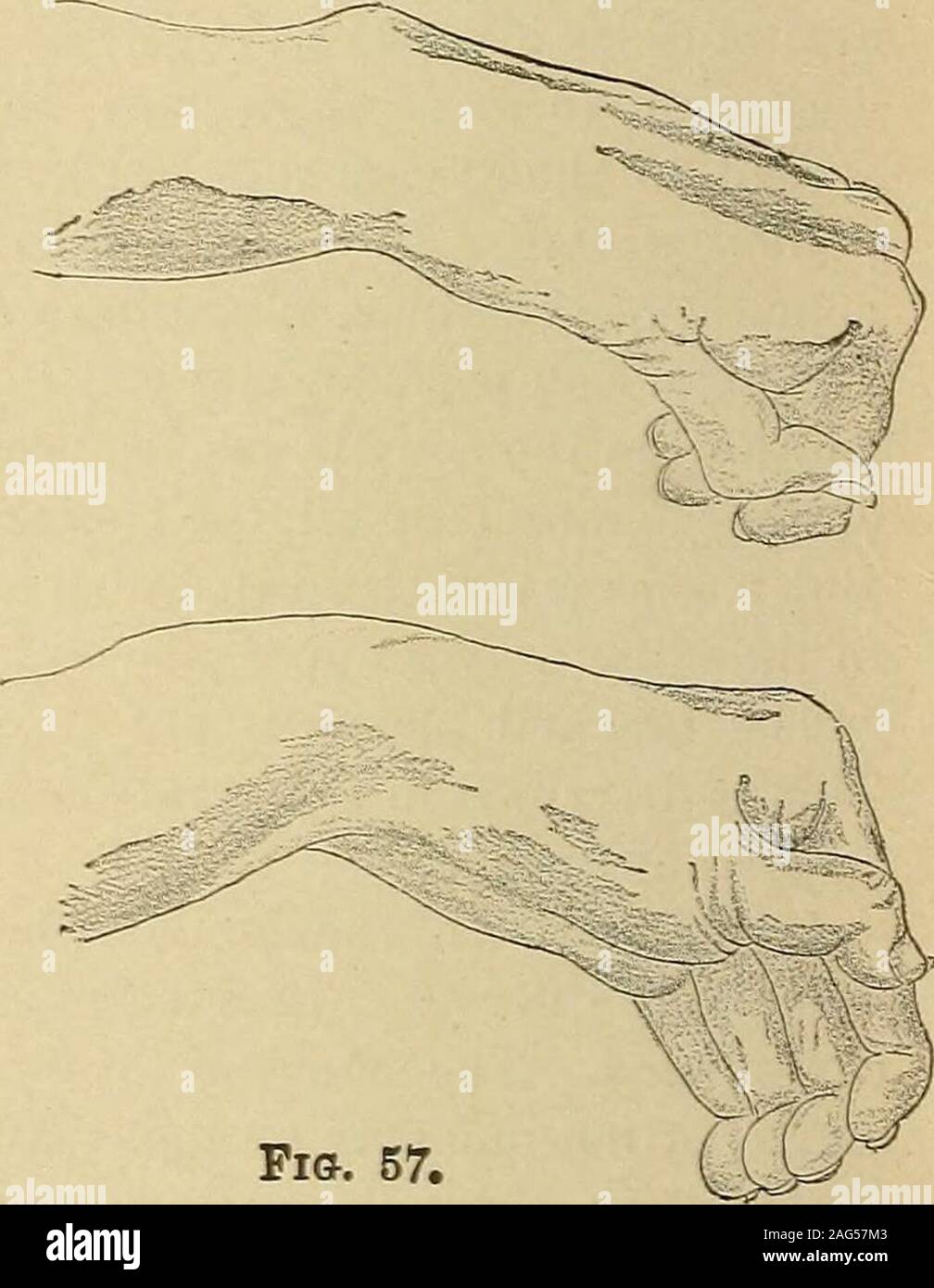 . Ein Handbuch von Krankheiten des Nervensystems. Pi &. 57. Schwein. 55. âCombined Lähmung des M. deltoideus, snpra - spinatns und infra-spinatns, von einem Sturz auf die Schulter. Feigen. 56, 57. âLeft Hand eines Patienten leiden unter einem Wachstum neben den unteren cervicalspine drückt die Nerv-Wurzeln. Es gab suppliedby ansesthesia aller Teile der A. brachialis und zervikalen Plexus. Der Arm war adducted, der Ellbogen gebeugt, thehand in der Haltung gezeigt, Flexion des ersten, Verlängerung der Zweiten, stark flexionof letzte Phalangen, die erste Phalanx der Daumen über - Erweiterte, die zweite Ausgelenkt. Steifigkeit extrem, und ein Versuch, ov Stockfoto
