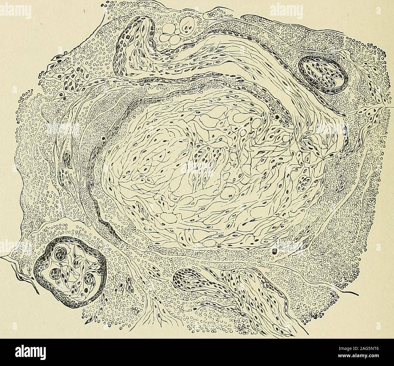 . Gynäkologische Pathologie; eine manuelle mikroskopische Technik und Diagnose in der gynäkologischen Praxis, für Studierende und Ärzte. b), die anderen beinga sehr dünne Schicht von Endothel, die vom bloodin die Räume zwischen den zotten als eine sehr dünne Membran gekennzeichnet. Die latterrepresents das Endothel der dilatierten mütterlichen Blutgefäßen. Inthese Epithelzellen sind nur Kerne gesehen, die in ahomogeneous Stoff ausgesetzt sind; Zelle Grenzen unterschieden werden nur bei einer 00 CHORIONZOTTEN. Frühe Periode (synzytium). In den späteren Monaten gibt es in der Regel onlyone Schicht des Epithels Stockfoto