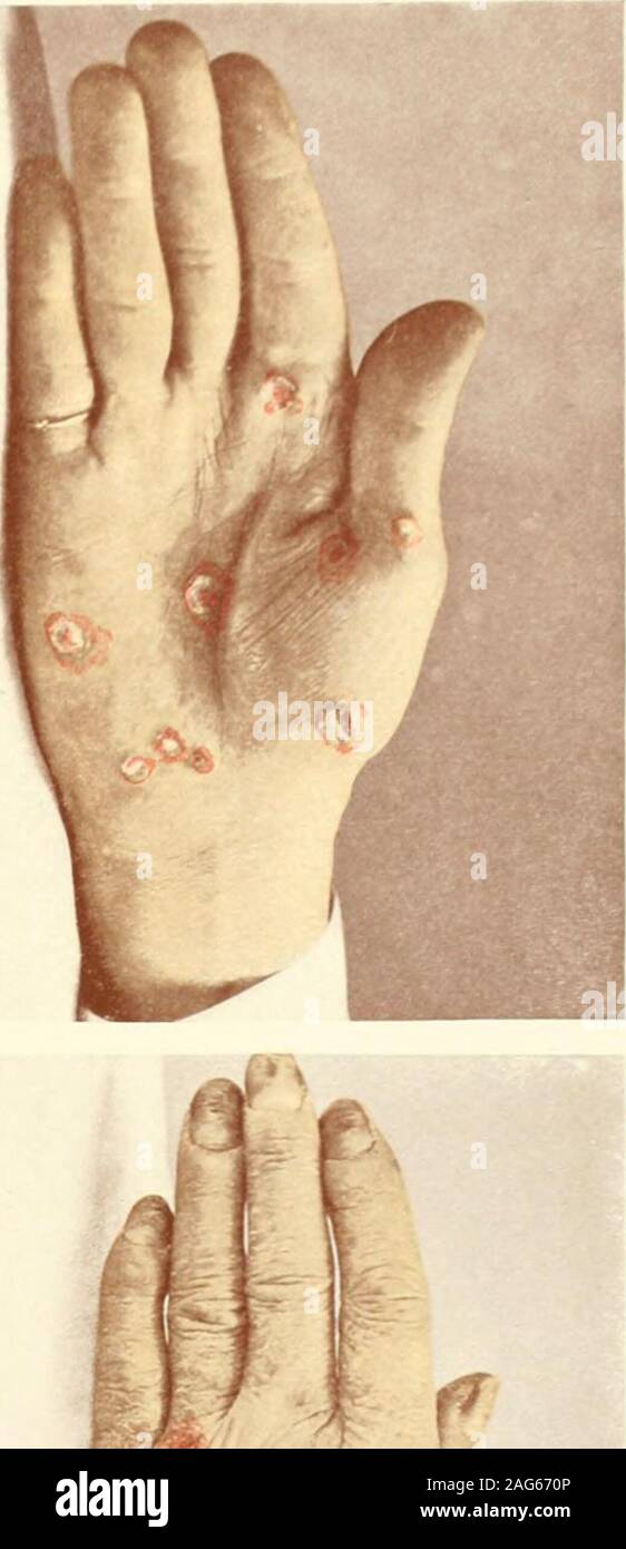 . Fotografische Atlas der Erkrankungen der Haut eine Reihe von 96 Platten, bestehend aus fast 200 Abbildungen, mit beschreibenden Text und eine Abhandlung über die kutane Therapeutika. Stockfoto