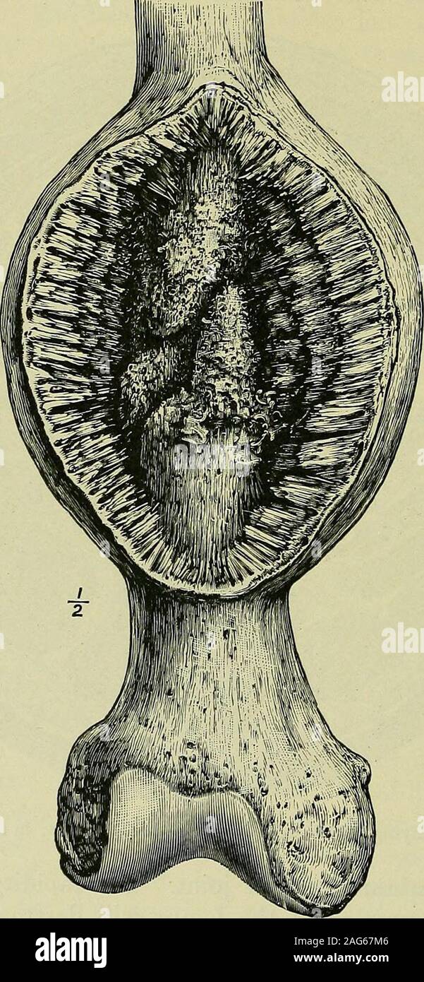 . Tumoren, unschuldig und bösartigen; ihre klinische Zeichen und die entsprechende Behandlung. Abb. 45. - Ein Erstarrender Spindel-celled Sarkom des Femur: im Querschnitt. synovial Membrane dieser Gemeinsamen. Die Geschwindigkeit, mit whicha periostaler Sarkom der Oberschenkelknochen zerstören den Patienten, vor allem, wenn es früh im Leben auftritt, ist im folgenden Fall dargestellt: - ein Mann 24 Jahre alt fühlte Schmerz Knie inhis; einen Monat später es wurde festgestellt, dass eine der unteren Ende seines Oberschenkels sarcomaoccupied. Zwei Monate afterwardshe kam und das Bein war promptlyamputated. Die tun^ Unsere, ein Periostaler Sarkom, Stockfoto