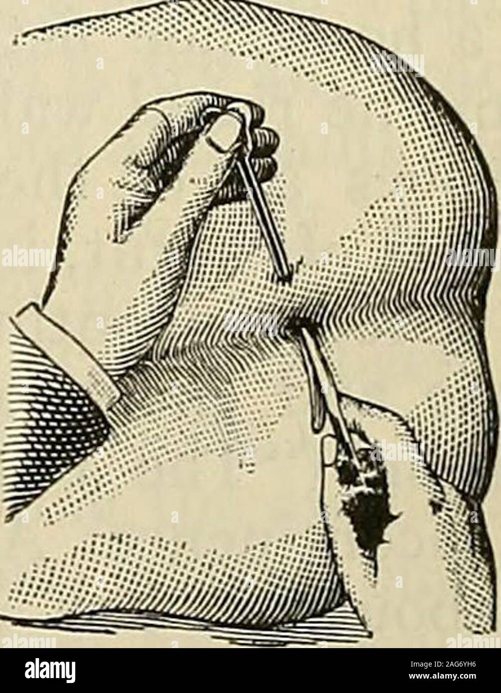 . Die moderne Chirurgie, allgemeine und operative. darf die Wunde mit Salzlösung, pack fest mit iodoformgauze Durchsickern zu verhindern, und Kleid mit Gaze und T-Verband. Die packingis entfernt in vierundzwanzig Stunden, es sei denn, es früher verschmutzt ist, in welchem Falle Sie ispromptly entfernt. Nach vierundzwanzig Stunden die Wunde ist bewässert und packedlightly mit Gaze zu seiner vollen Tiefe. Dieses Dressing sollte wiederholt werden, den Alltag und die Überbrückung der Gewebe sollte durch eine Sonde gebrochen werden. Wenn die Wunde wird träge, Es stimuliert wird mit Nitrat aus Silber und sodiumiodid ist in kleinen Dosen drei Mal verliehen Stockfoto