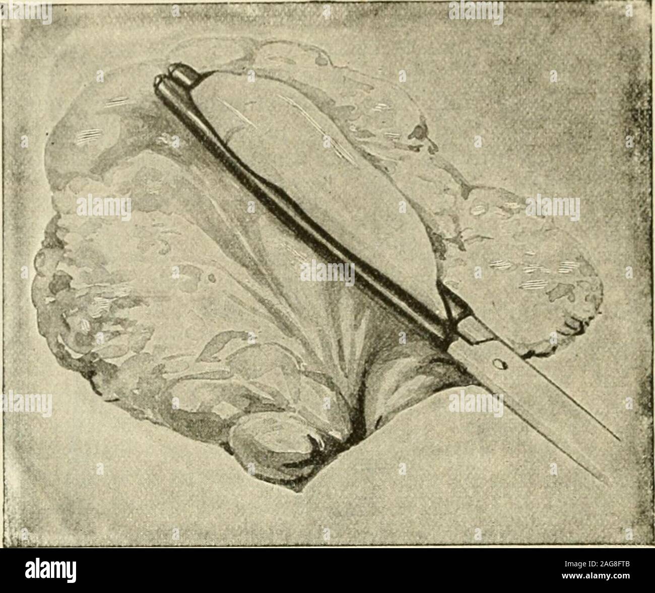 . Die moderne Chirurgie, allgemeine und operativen. Abb. 758.- Fowlers Methode der gastro-enterostomy. Abb. 759.-- Moynihans feuchten forgastric und intestinalen Operationen (durch die Brüder, London). Mitte Koliken Arterie, holen Sie sich ein bisschen von der unter der Oberfläche des mesocolonby ein paar Blutstillung Pinzetten, es von der posterioren stomachwall Lift, und öffnen Sie die geringeren sac von bauchfell von der Schere. Vergrößern theopening durch Dilatation oder reißen, bis er läßt zu, daß drei Finger. Prüfen Sie den hinteren andfeel Magenwand. Platzieren Sie den Magen in ihrer natürlichen Position, markieren Sie mit dem Daumen den untersten Teil des posterioren St Stockfoto