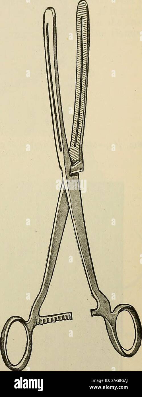 . Die moderne Chirurgie, allgemeine und operativen. Abb. 758.- Fowlers Methode der gastro-enterostomy. Abb. 759.-- Moynihans feuchten forgastric und intestinalen Operationen (durch die Brüder, London). Mitte Koliken Arterie, holen Sie sich ein bisschen von der unter der Oberfläche des mesocolonby ein paar Blutstillung Pinzetten, es von der posterioren stomachwall Lift, und öffnen Sie die geringeren sac von bauchfell von der Schere. Vergrößern theopening durch Dilatation oder reißen, bis er läßt zu, daß drei Finger. Prüfen Sie den hinteren andfeel Magenwand. Platzieren Sie den Magen in ihrer natürlichen Position, markieren Sie mit dem Daumen den untersten Teil des posterioren St Stockfoto