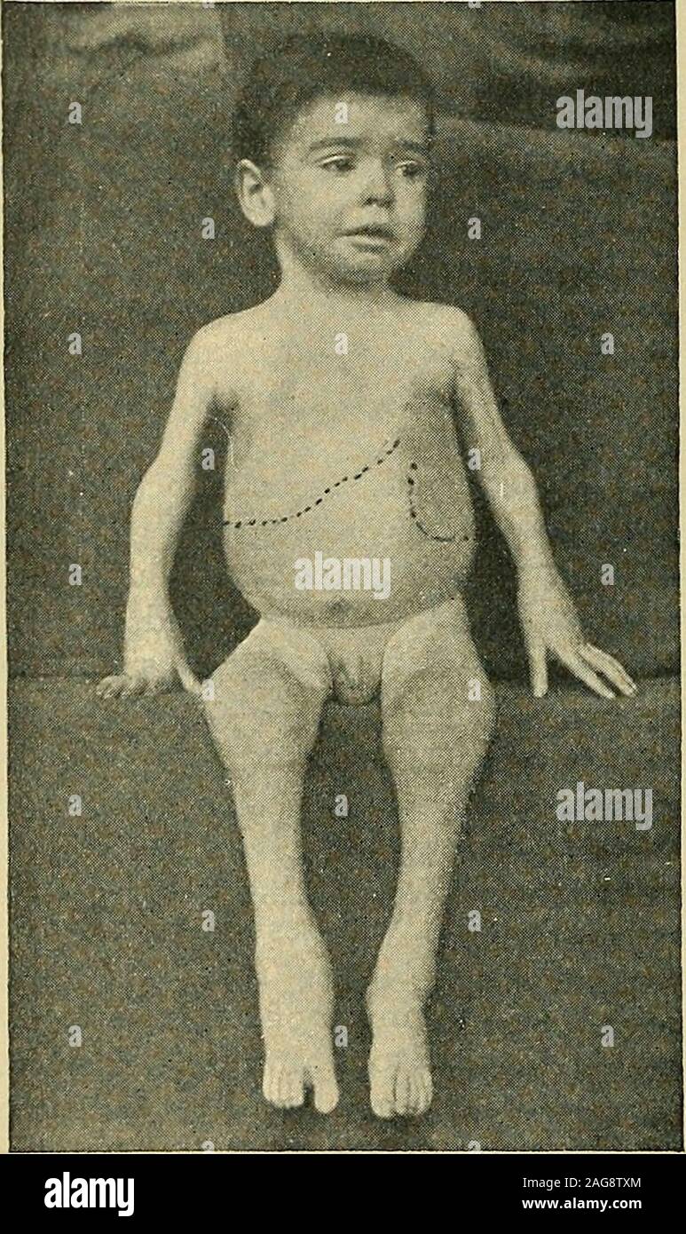 . Die Krankheiten der Kinder: medizinische und chirurgische. senlargement der Drüsen andspleen. Diese Drüsen hyperplasiasuggests Hodgkins Krankheit; theaxillary Drüsen und Drüsen in thegroin und posterioren Dreieck der Hals sind am häufigsten betroffen. Die Mesenterial-, Leber-, andsplenic Drüsen kann auch sein eigenes Larged. Die Milz scheint ständig zu vergrössern. Die Anämie ist vorhanden, und es gibt periodische Fieber. Der Verlauf der Krankheit ist chronisch. Es scheint eine besondere liabiHtyto Perikarditis und pleuritis. In unserem Fall waren wir misstrauisch Hodg-kins Krankheit aufgrund der erweiterten Drüsen Stockfoto