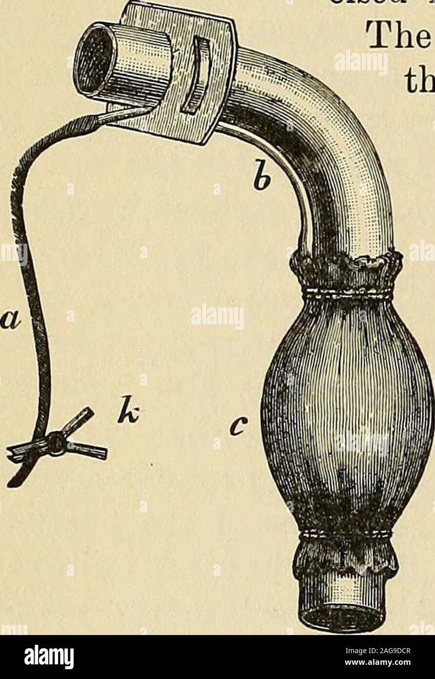 . Operative Chirurgie. Führt die ordentlichen Tracheotomie tubeinto das offene Ende der Luftröhre statt durch eine tracheotomie Wunde, und die ansesthetic durch das Rohr weiter. Die späteren Schritte des Opera- tion ist die gleiche wie oben beschrieben. Um nicht in Verlegenheit zu bringen Derbetreiber den Flansch der tracheotomie Rohr nur an den Seiten Projekt sollte, wie die Breite obere Grenze des Flansches mit Andie Zugang Teile am Anfang der Ausbau des Kehlkopfes stören. Der Aktionsplan zum Ausdruck und wurde von den scharfen praktiziert reduziert die dangerfrom Infektion auf ein Minimum und kurze Stockfoto
