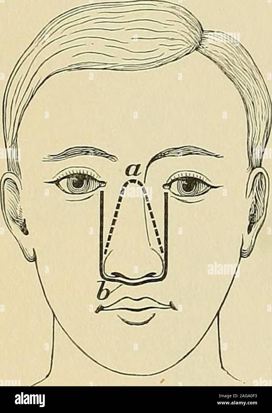. Operative Chirurgie. Die konvexe Teil der Wurzel von thenose zwischen den Augen, Kreuz, während die Arme nach unten auf jeder Seite von thenose an den äußeren Grenzen der Alse (Fettiger) (Abb. erweitern. 837, a). Die Knochen sind dann durch die in der Zeile der Inzision gesägt, theseptum befreit an Ihren unter der Oberfläche, und thenose nach unten gedreht, damit entlarven die interiorof der Nasenhöhle zu beobachten und manipula- tion. Wenn das Wachstum ein großes und greaterspace werden notwendig sein, der Schnitt kann geändert werden (Abb. 843, a) wie durch die gestrichelte Linie dargestellt, und thebones in seinem Kurs liegen gesägt t Stockfoto
