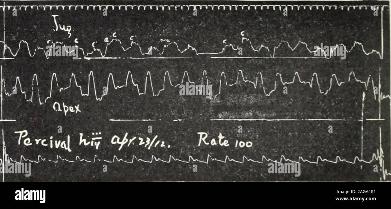 . Amerikanische Arzt. Abb. 14 Abb. 15. Abb., I&gt; Feigen. 14. 15 Und [6. Congelador Vorhofflimmern und komplette hea. k entwickeln - in einem Fall mit normalen Rhythmus ing. Bei Leberzirrhose, schwache heartwith normalen Rhythmus. Digipuratum Gr. s Sie tid wurde von pvi gegeben! 17 bis 20, bei der Verfolgung der 14 zeigte congelador Kammerflimmern und kompletter Herzblock, Rate 42. Das Medikament wurde gestoppt und zwei Tage später Tracing 15 zeigte Congelador fibrilla- allein, über 135. Tracing [6, den nächsten Tag genommen, zeigte ausfüllt Normale rlivthm. Tarif 100. Original Artikel 621^M^M f^j 1 1 Abb. 17 Abb. 17. Gekoppelte rhy Stockfoto