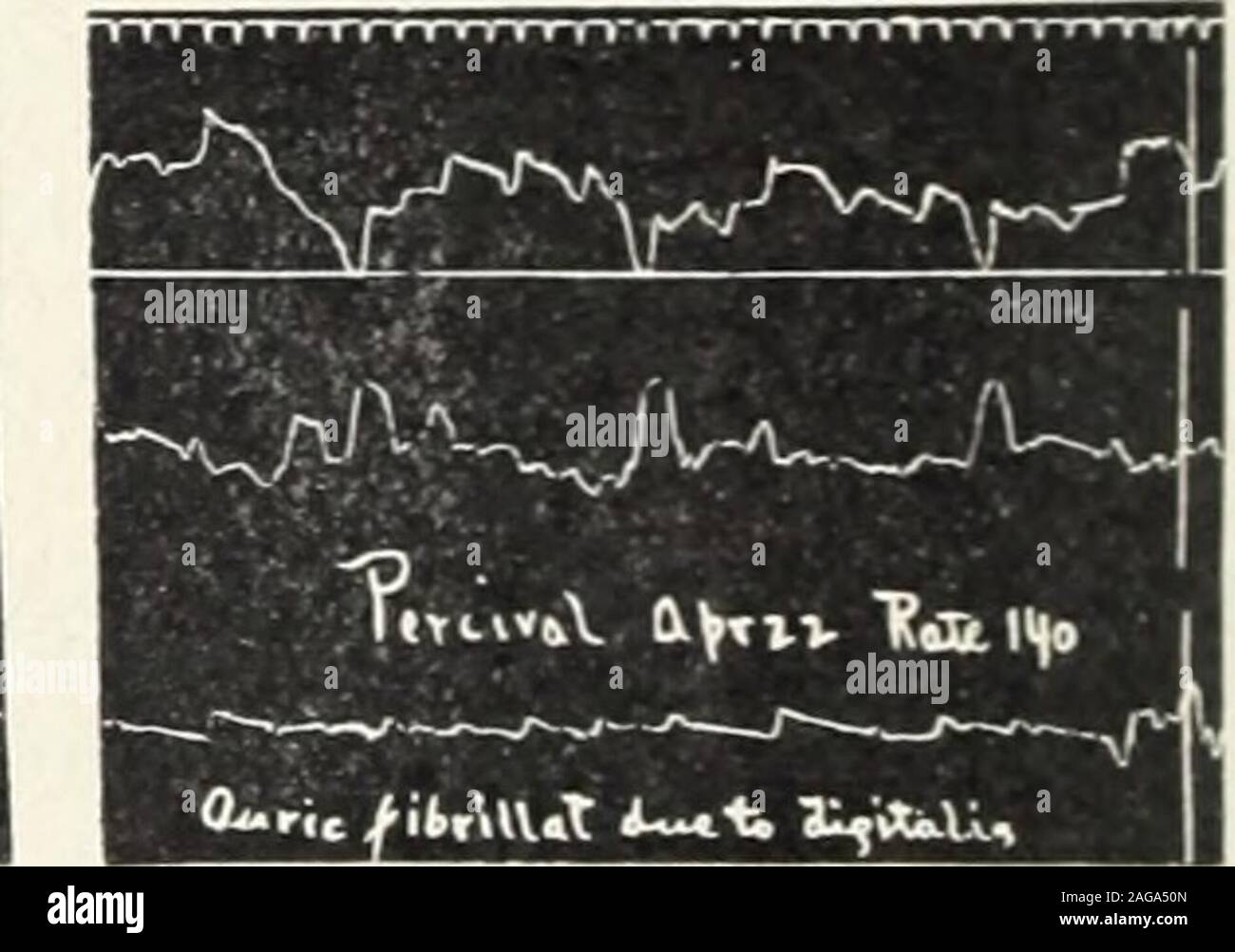 . Amerikanische Arzt. Tanne,. T3-Abbn. 12. und 13. Kompletter Herzblock Entwicklung in einem Fall mit auricularfibrillation. Auf den Eintritt (Tracing 12) der Ventrikel sehr irregularrate war 146 zu 160, mit einem Zählbaren radial Pulse von 80 bis 84. Infusion ofdigitalis 5 iv Sie tid für elf Tage gegeben wurde, dann gestoppt. In diesem timedas Impuls wurde fast regelmäßig, Rate über 72. Vier Tage später Tastung 1.3 wastaken, der Puls wird ziemlich regelmäßigen Rate 54. Drei Tage später, d. h. eine weekafter zum Stillstand der Droge, den kompletten Block noch vorhanden war, theventricular Tarif verbleibenden zwischen -0 und 60. f^T Stockfoto
