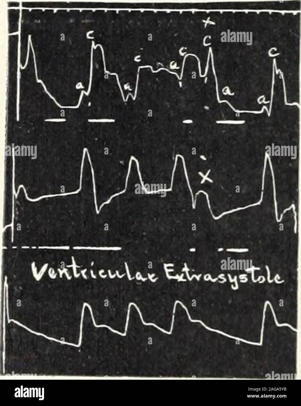 . Amerikanische Arzt. Abb. s Feigen. 4. und 5. Kompletter Herzblock. - Entwicklung nach digipuratumgr. iss Ti. d. für 9 Tage. Tracing 5 zeigt wieder in den normalen Rhythmus nach digitaliseffekt getragen hatte. 6 i 8 Der amerikanische Arzt l, h, i/VAx ich Vtlvtau-u-lo-t E*Tx^=lj Stolen i.E., LsvusTri" "v" cyout-s Abb. 7. [3 Y 0 O ItqC rt-C-! - Fyjiic Stockfoto