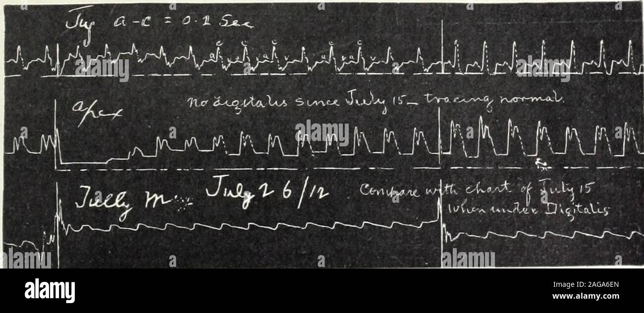 . Amerikanische Arzt. Abb. 2y^x, ein fWt? Av*. &Gt; -1 PV^ fc. " v. x&gt;, ... J rC,. r Abb. 3 Abb. 3. Teilweise Herzblock. - 2:1 Rhythmus, Entwicklung, (Höhe unbekannt), in einem Herzen mit normalen Rhythmus. Nach Digitalis |. Tn &gt; Tim m • nnr-&lt; - rrrro-nnirn-n Uut. a. v. Rntm-rr.- mmnrm-. TnT f rm-&Lt;7" t 1 1 1 1 "TifTr Ti/tf j3 cAA-^^^^^^^&;. T MR-J^^-K - ^^VJ-PH-^. f-V-^ jMt-J W". a. ^.- ftVf. o trtnttLOM-Vt * &lt;&: u ut Ich." Iww {n! Abb. 4. Abb. s Feigen. 4. und 5. Kompletter Herzblock. - Entwicklung nach digipuratumgr. iss Ti. d. für 9 Tage. Tracing 5 zeigt wieder in den normalen Rhythmus nach Digitalis Stockfoto