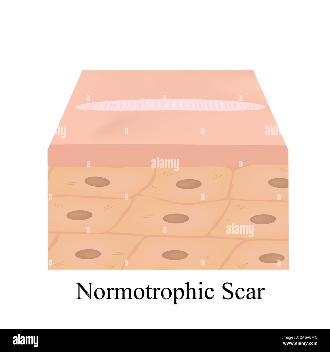 Narben normotrophic. Die anatomische Struktur der Haut Narbe. Vector Illustration auf isolierte Hintergrund. Stock Vektor