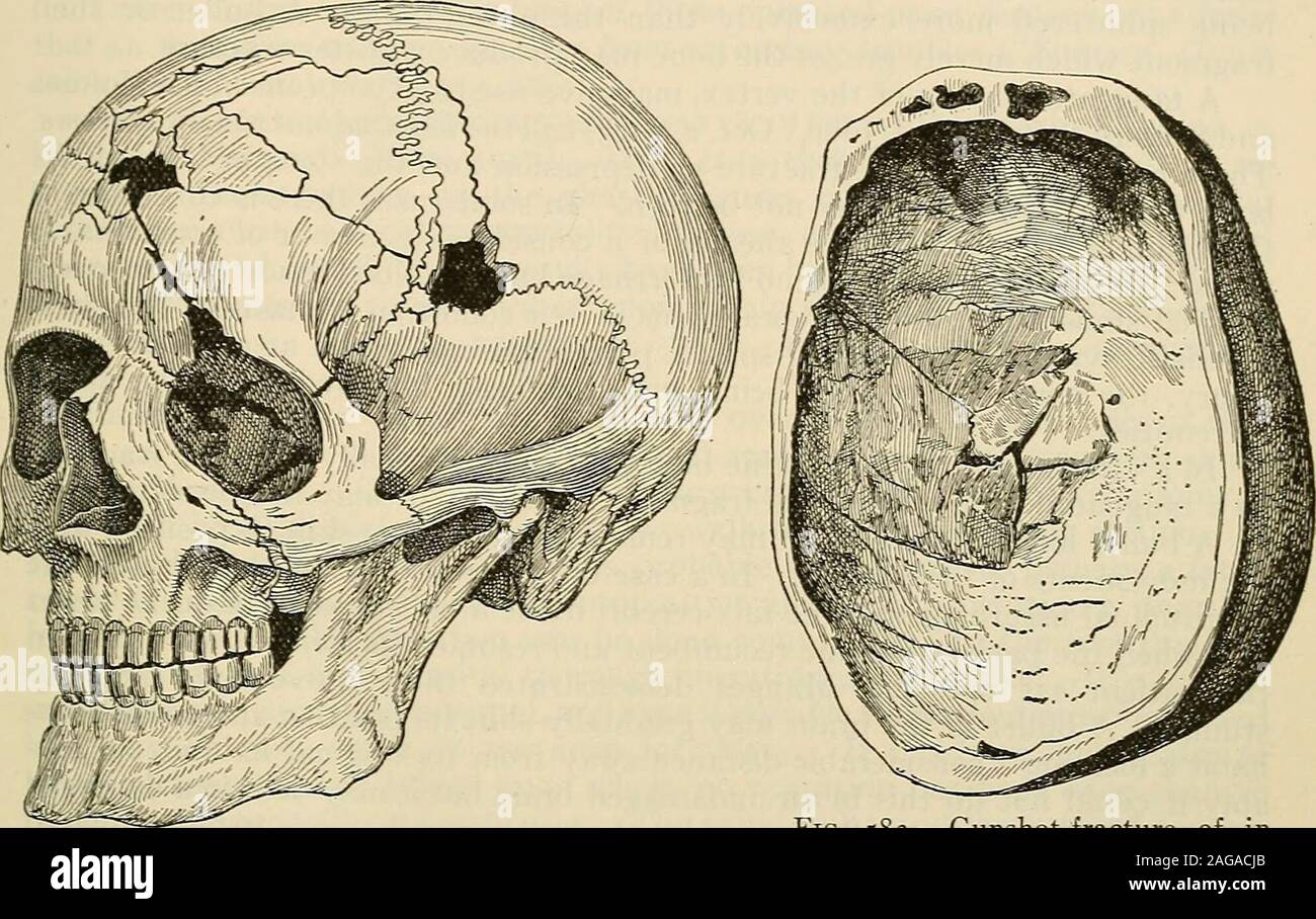 . Die moderne Chirurgie, allgemeine und operativen. Die Lokalisierung der Symptome existieren, und Enzephalitis mit Koma ist aptto ergeben. Abszess mav folgen. Wunden im Krieg 891 bei der Behandlung von Wunden des Gehirns immer die gesamte Kopfhaut und examinethe Waffe rasieren, wenn möglich, um zu sehen, ob ein Stück abgebrochen wurde. Antisepticize, en-groß die Wunde, trephine, Festnahme Blutungen, keine Depressionen, removeforeign Körper erhöhen, darf die Wunde% ath Salzlösung, ablassen, Gaze, suturethe Dura, Kleid, und urotropin verwalten. Wunden im Krieg. - Wenn die Kugel eines militärischen Gewehr, feuerte auf sehr closerange, kreuze das Gehirn ich Stockfoto