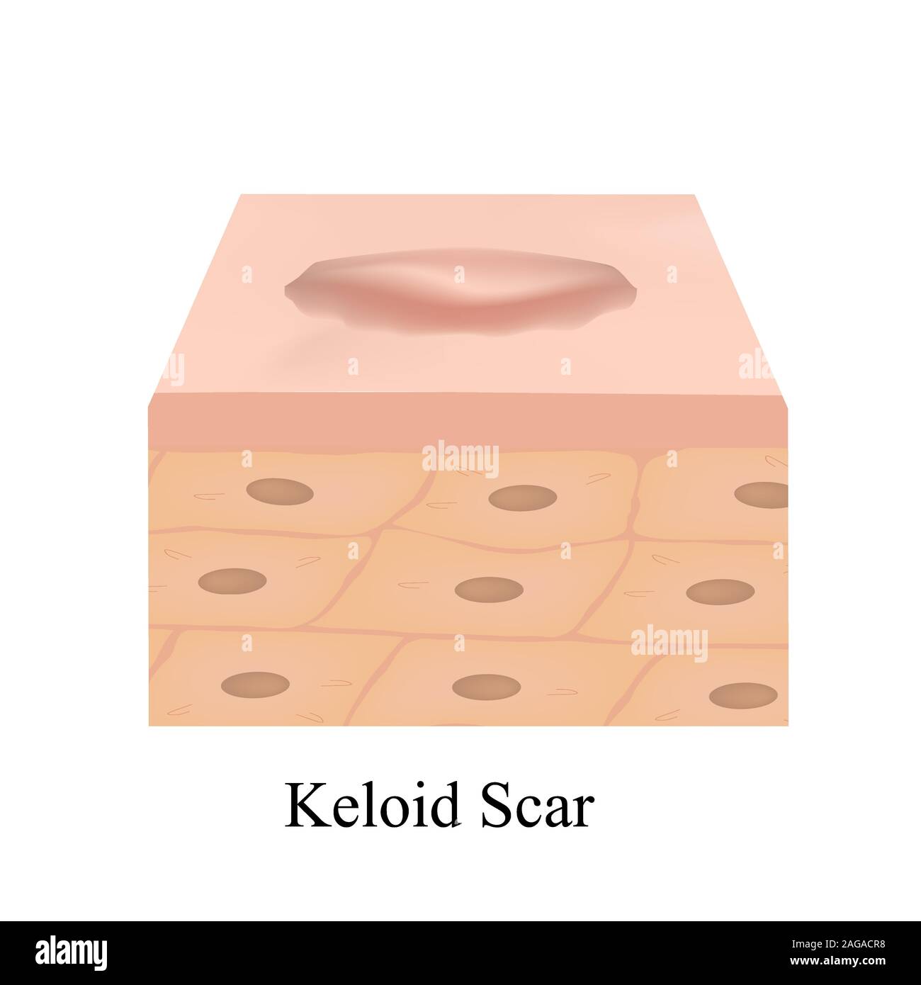 Narben, Keloide. Die anatomische Struktur der Haut Narbe. Vector Illustration auf isolierte Hintergrund. Stock Vektor