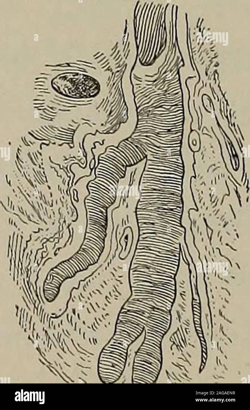. Krankheiten der Kinder. Abb. 23. bronchiektasien c, Sakkulären; 6