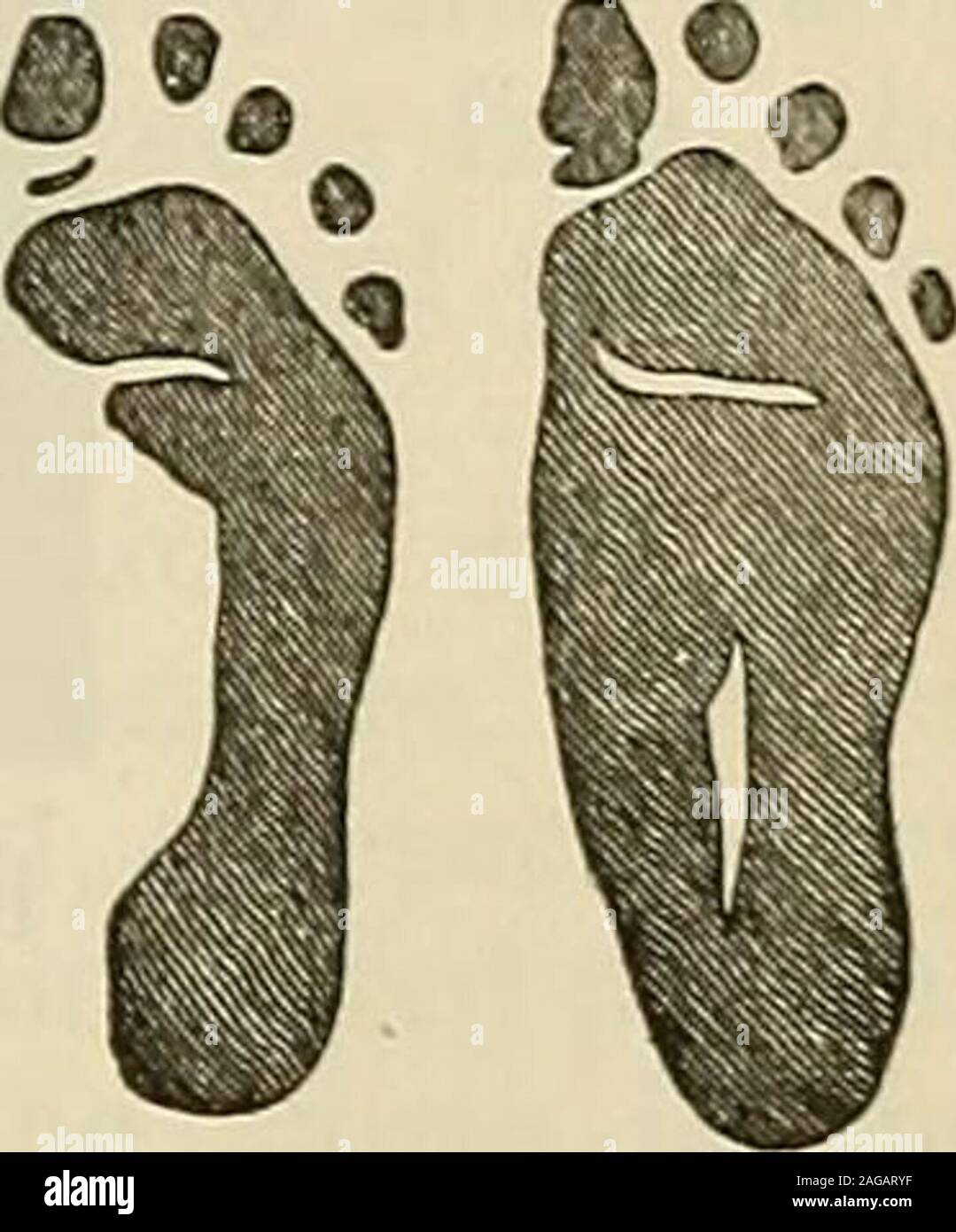 . Die moderne Chirurgie, allgemeine und operativen. Oder die Entfernung des Quaders oder othertarsal Knochen, kann angezeigt werden. Buchanan beschäftigt subkutane Geschäftsbereich Alle resistenten Strukturen. Gelegentlich, bei rezidivierendem und eingefleischte Fällen astragalectomy durchgeführt wird. Es ist selten bei jungen Kindern (siehe Seite 795) geübt. In einigen Fällen von talipes calcaneus Verkürzung der tendoAchilis wird empfohlen; aber eine solche Operation ist nur der vorübergehenden Wert, stretch-ing nach zwei oder mehr Jahren auftritt. In talipes wegen Kinderlähmung theoperative Behandlung ist das Gleiche, aber wir sollten nicht in Plast blockieren. Stockfoto