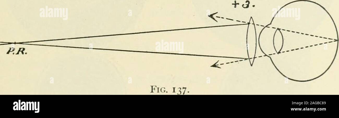 . Lichtbrechung und wie brechen: der Optik, retinoscopy, das Anbringen von Brillen und Brillen, etc.. Fu;. 136.-TIk; Autoren nachschauen Auge für Stu &Lt;lyinp; Ki-tiiK) scoi) y. verurteilt als Methode der tiio estimatini; die Brechung eines e) - cby reflektiert in es Strahlen der Lii^ht Axiin eine Ebene oder konkav 154 RETINOSCOPV. 155 Spiegel, und beobachten Sie die Bewegung, die die retinalillumination Macht durch Drehen der Spiegel. Vorschlag. - Vor dem retinoscopyupon das menschliche Auge zu üben, der Anfänger wird empfohlen themethod auf einem der vielen schematischen Augen zu studieren foundi werden Stockfoto