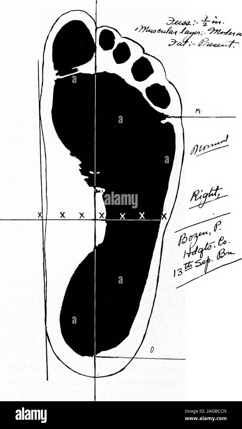 . Ein Handbuch zu Fuß und Schuh Fitting für Offiziere der US Navy und des US Marine Corps. Ron den Fuß, der sich ein Jet Black imprintof. Die Formel der tannicacid Lösung ist: - Gerbsäure gm.x (wt.) Alkohol 90 c.c. Die Zeilen und Hilfslinien sind jetzt auf thepedograph Für die Einschätzung der Behinderung gezeichnet, wenn vorhanden. Die erste Base Line wird an einem Punkt posterior zu: Diemasseschrauben malleolus zum ersten Metatarsophalangealgelenks gezeichnet. Darüber hinausgehende Thecontour Zeile zeigt den Grad der Inver-sion. Die Linie der Achse Gewicht Lager Nächsten soweit nachspannen, dass die Mitte der Ferse t gezeichnet Stockfoto