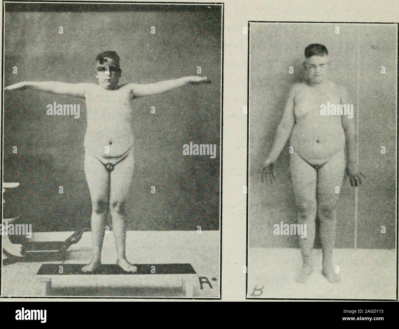 . Endokrinologie. Der Hals, 2 Ein-/4,- (5,75 cm.). Es war-- Gewicht von 346 bis 274 lbs; und der systolische Blutdruck Druck von 158 bis 135 mm. Vergleichende Tabelle der Messungen März 3, 1918 Julv 1, 1918 Gewicht 346 lbs lbs 2741/2 Maße: Kinn auf 25 %. (65 cm) 22. (56 cm) Hals 201/2 in. (52 cm) IBV * in. (46 cm) Brust 51. (130 cm) 44 y 2 in. (113 cm) Nabel 521/2 in. (133 cm) 46. (117 cm) Hüfte 59. (150 cm) 431/2 in. (110 cm) Oberschenkel (an der Kreuzung der oberen und mittleren Drittel) 21. (53 cm) 21. (53 cm) Kalb 15 in. (38 cm) 141/2 in. (37 cm) Humerus ICH 61 Stockfoto