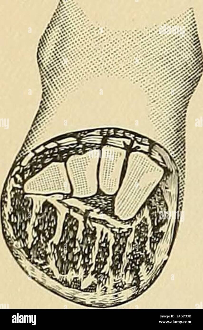 . Operative Chirurgie. Abb. 572.- die Trennung der zweiten Mittelfußknochen. Abb. 573.- plantar Klappe. dritten Artikulationen. überspringen Die zweite und öffnen Sie die erste. Die Artikulation zweite mit der Keilschrift Knochen ofthe ist eigentümlich, dass es ungefähr zwei fifthsof ein Zoll höher als die Erste und die Dritte (Abbn. 571, h, und 572). Aber mit den Knochen gedrückt, einen kurzen Quer schnitt befreit die dorsale Con- 504 operative Chirurgie. Abb. 574.- Erscheinen - Tanz der Klappe (LIS-Franken amputa-). Anschlüsse mit der mittleren keilförmigen, nach denen es aus: Diemasseschrauben und externe Keilschrift Knochen getrennt ist, Stockfoto