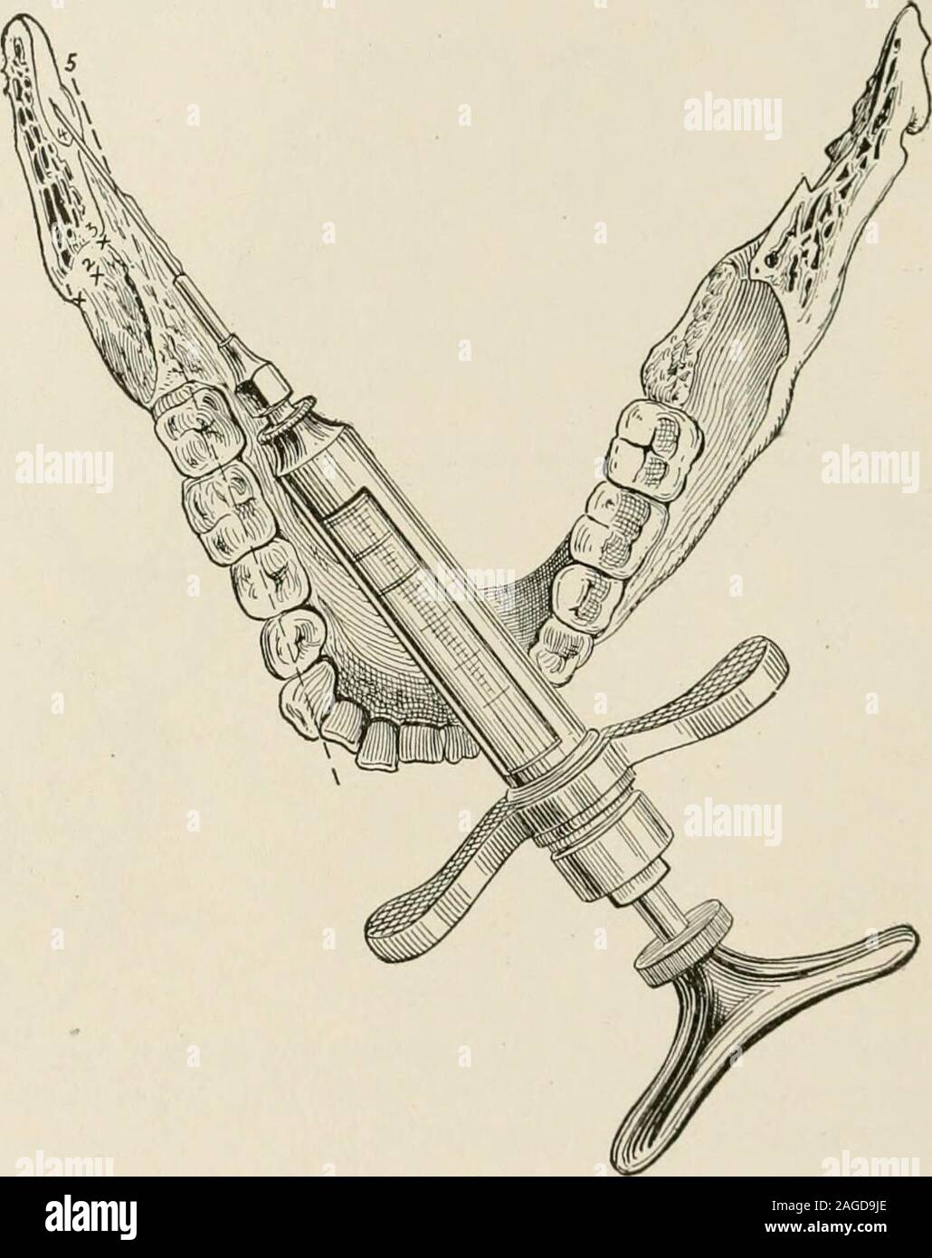 . Lokale und regionale Anästhesie; mit Kapiteln über spinale epidurale, der Paarvertebralen und parasacral Analgesie und andere Anwendungen, die die lokalen und regionalen Anästhesie zur Chirurgie des Auge, Ohr, Nase und Hals und zur zahnmedizinischen Praxis. obHque Leitung ist mit dem Finger-Nagel, und theneedle eingefügt in der Nähe der Nagel in die Schleimhaut in der Nähe, doch nicht im sofort an, den Rand der Knochen (Abbn. 188, 192, 193). Die Spritze ist horizontal nach vorn geschoben und Posterior vonder Hunde-, auf der anderen Seite entlang der inneren Oberfläche der Mann - dibular Hälfte anästhesiert werden (Abbn. 188, 189, Stockfoto