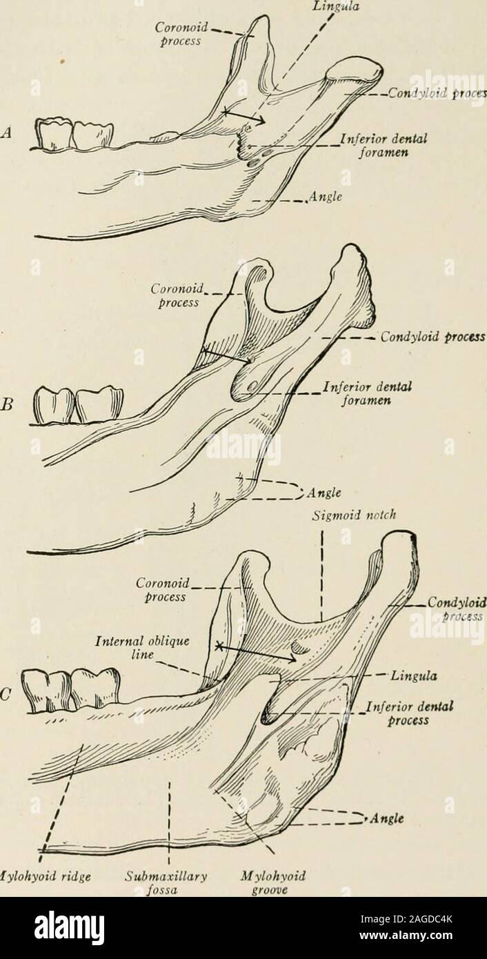 . Lokale und regionale Anästhesie; mit Kapiteln über spinale epidurale, der Paarvertebralen und parasacral Analgesie und andere Anwendungen, die die lokalen und regionalen Anästhesie zur Chirurgie des Auge, Ohr, Nase und Hals, und in der zahnmedizinischen Praxis. - Coronoid Prozeß Interner oblique lineExternal schräge Interne obliqueline - Mental foramen Abb. 186.-Verhältnis der aufsteigenden Unterkieferast auf den Körper des Kiefers. Die arrowindicates, in welche Richtung die Spritze mit der minderwertigen dentalforamen erweitert werden sollte. (Nach Fischer.) Das foramen selbst, in der Erwachsene, liegt stets über der alveolarridg gelegen Stockfoto