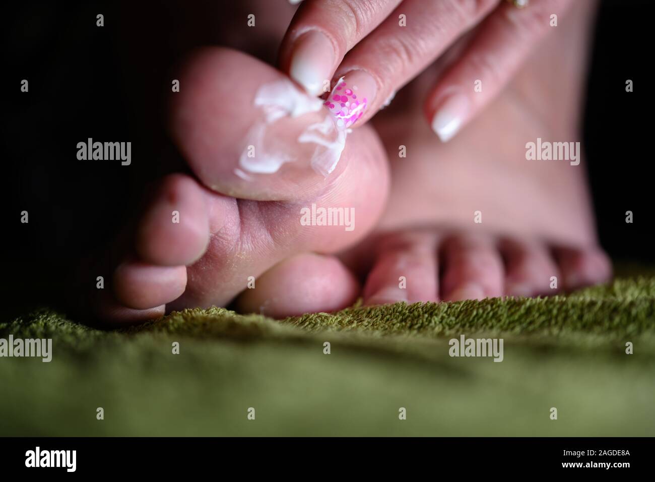 Finger appling Lotion zu Fuß mit Pilzbefall. Althele den Fuß können zu schweren Juckreiz, Bläschen, reddness und stinkenden Füße verursachen Stockfoto