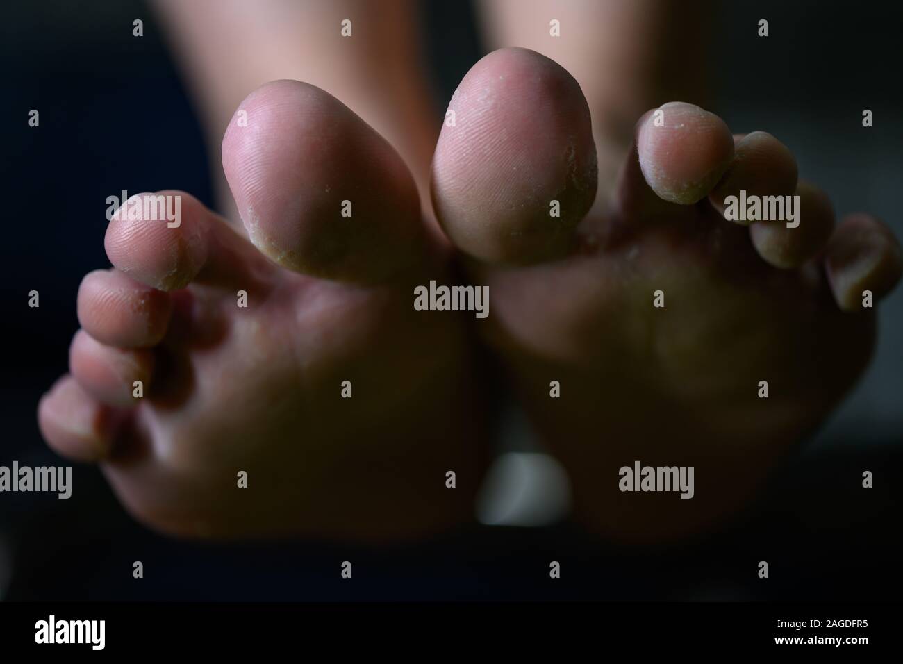 Nahaufnahme von Frau Füße in tinea pedis Pilz ist althlete Infektion. Pathogene ansteckende Krankheit, die leicht von kontaminierten Flo erworben werden können Stockfoto