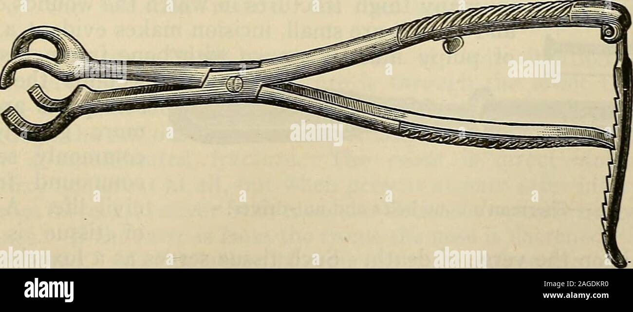 . Die moderne Chirurgie, allgemeine und operativen. Abb. - Rahmen für Fahrwerk und Erweiterung. Nützliche Langenbecks Instrument, sichert absolute Unbeweglichkeit und ist ein veryinstrument. Manchmal Union nicht gelingt, trotz der gewaltigen Operation. In diesen Fällen ist keine Neigung zu Knochen Produktion. Ein Knochen-graft kann teilweise separatedfrom werden eines der Fragmente und dar, das zwischen die belebte endet, ein Knochen-graft kann aus der Tibia und zwischengeschaltet (albees Methode). Abb. 327.- Lowman-Lambotte Knochen-holding Pinzetten. Frische knochen splittern kann zwischengeschaltet werden, oder einen Teil einer Rippe kann withscre verwendet werden. Stockfoto