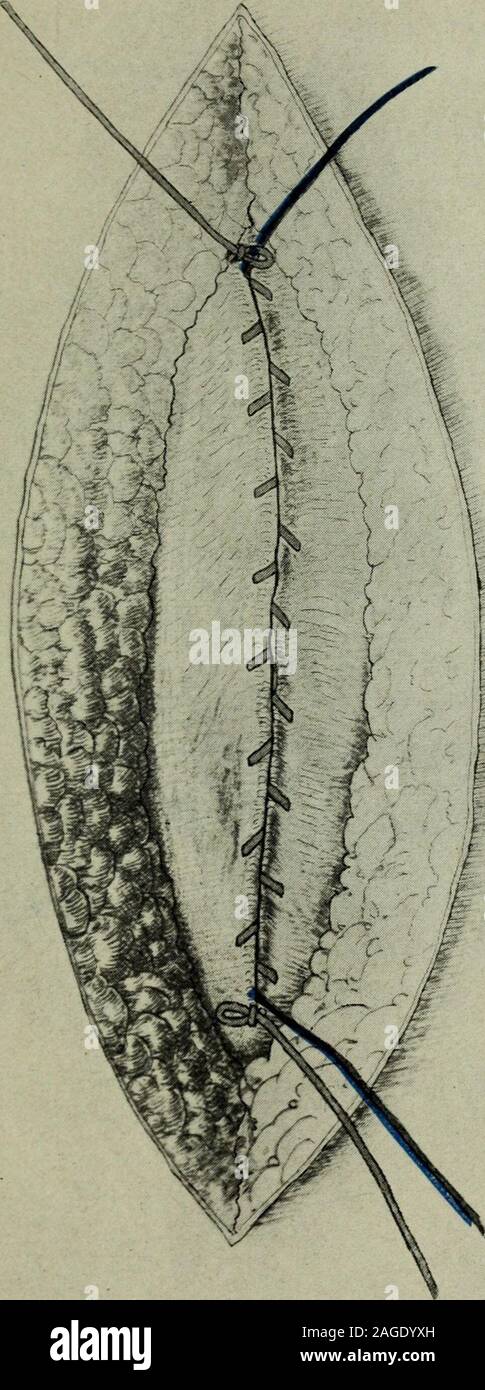 . Plexus. Abb. 1.- Naht des Bauchfells. #*&Lt; ** *&lt; * H. Abb. 2 - Naht von der Linea alba, in Position V" gebunden Stockfoto