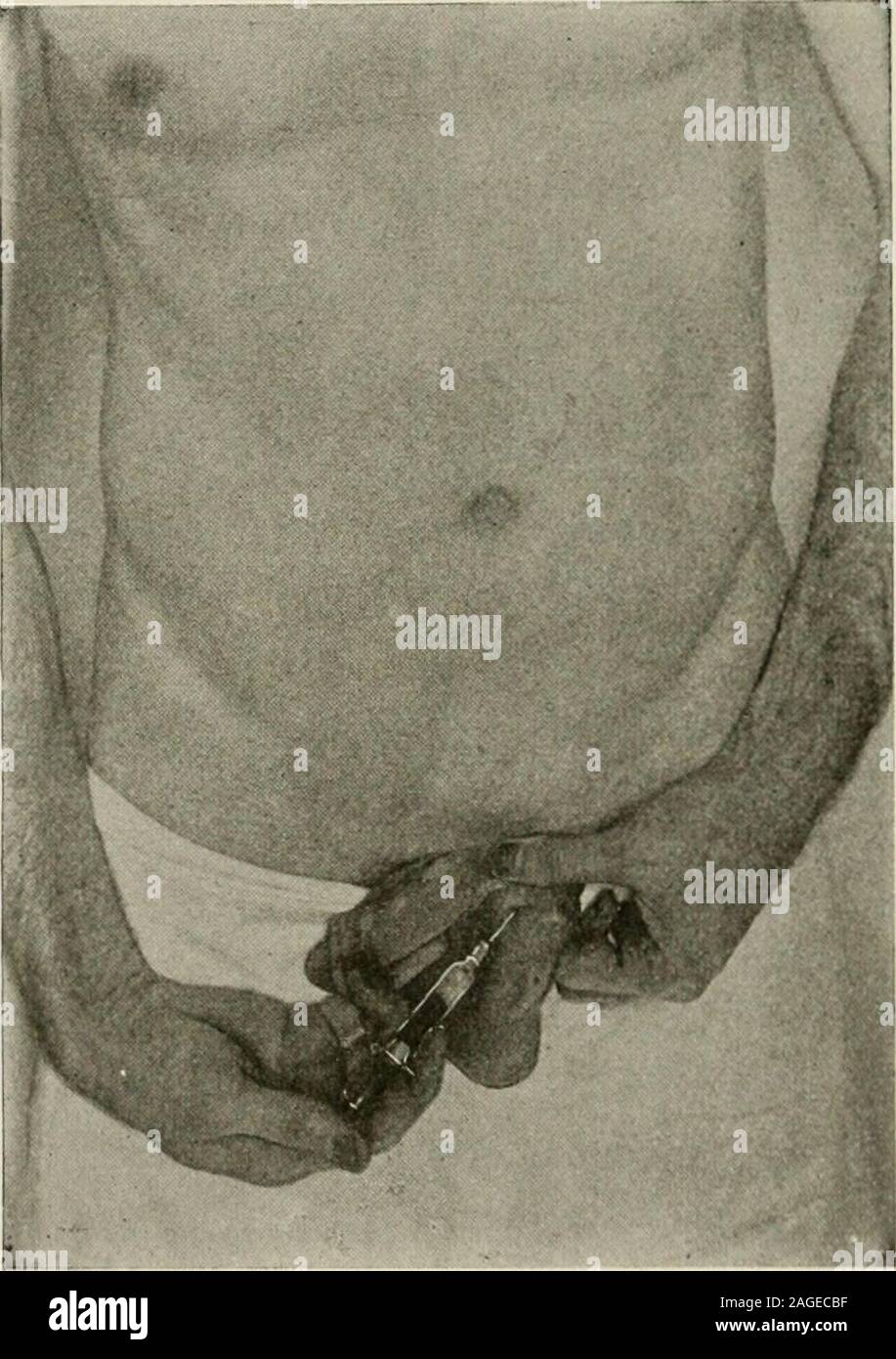 . Lokale und regionale Anästhesie; mit Kapiteln über spinale epidurale, der Paarvertebralen und parasacral Analgesie und andere Anwendungen, die die lokalen und regionalen Anästhesie zur Chirurgie des Auge, Ohr, Nase und Hals, und in der zahnmedizinischen Praxis. ) In engem Kontakt mit; einige opera- Spritzen in die Schnur so. Aber ich finde es besser, nicht so zu tun, als eine Vene verletzt, und, während der keine Folge, und Es mightproduce ein hämatom oder verfärben das Feld mit Blut, und als Thecord wird später nichts ausgesetzt sein wird. Der Schnitt wird dann 392 lokale Anästhesie durch den Anästhesierten Stockfoto