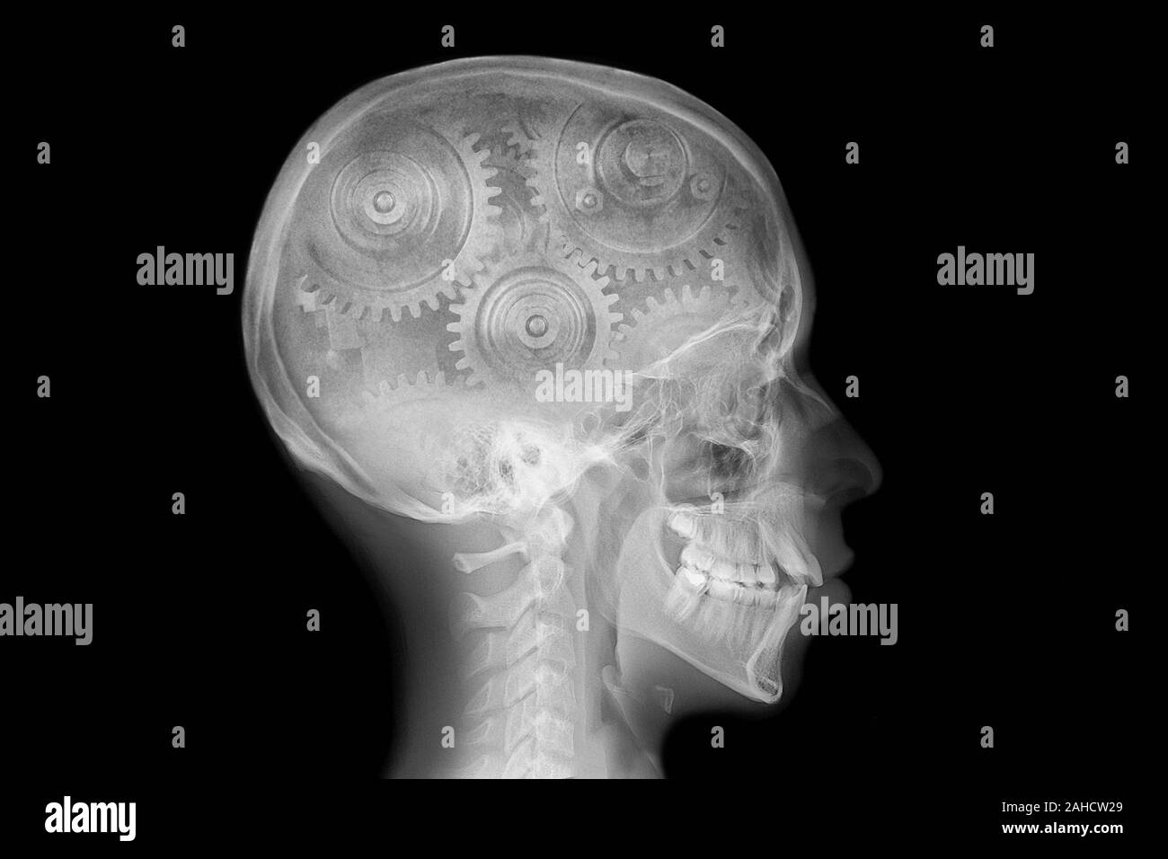 Schädel xray mit Hohlrad Stockfoto