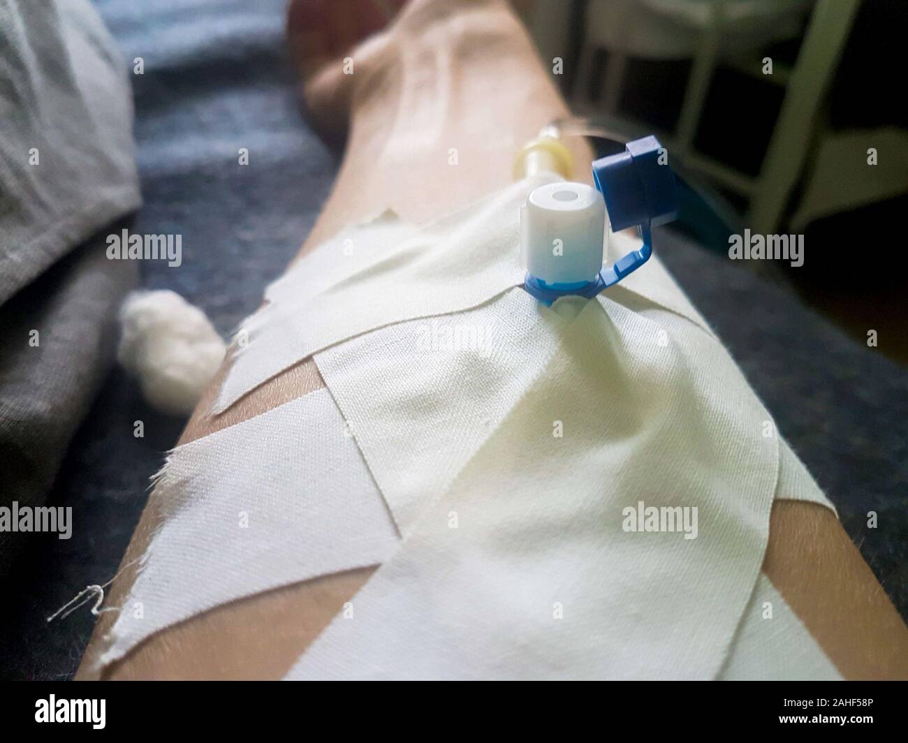 Periphere Venenkatheter in der Ader der menschlichen Hand. Stockfoto