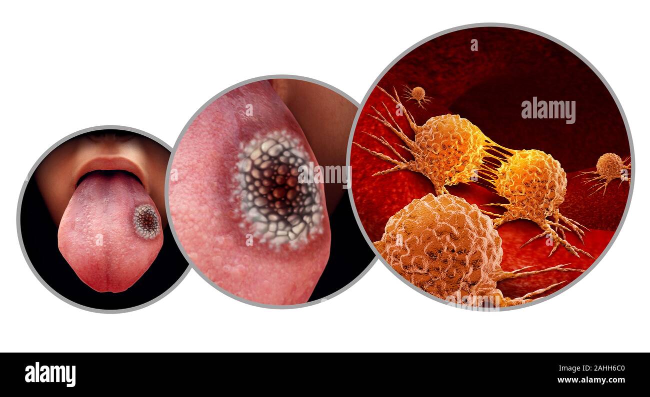 Zungenkrebs medizinisches Konzept oder plattenepithelkarzinom wie bösartige Tumorerkrankungen im Mund. Stockfoto