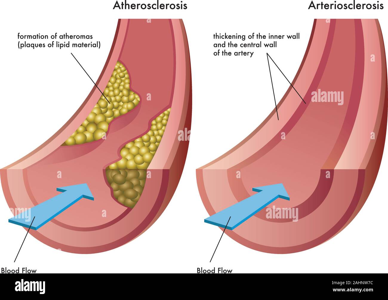 Medizinische Illustration der Unterschiede zwischen Arteriosklerose und Arteriosklerose. Stock Vektor