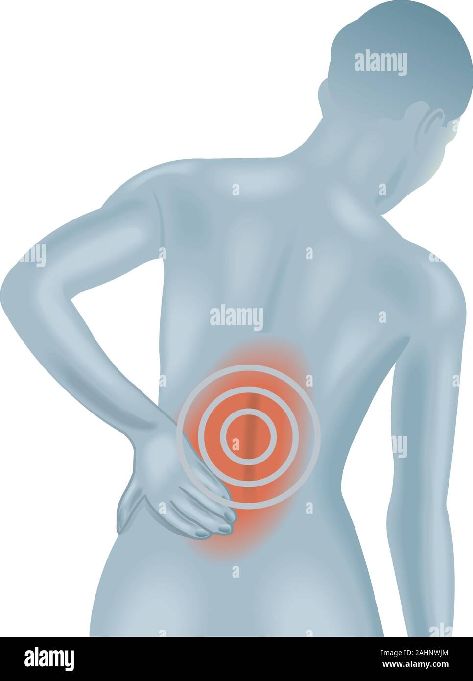 Medizinische Illustration der Symptome von Rückenschmerzen. Stock Vektor
