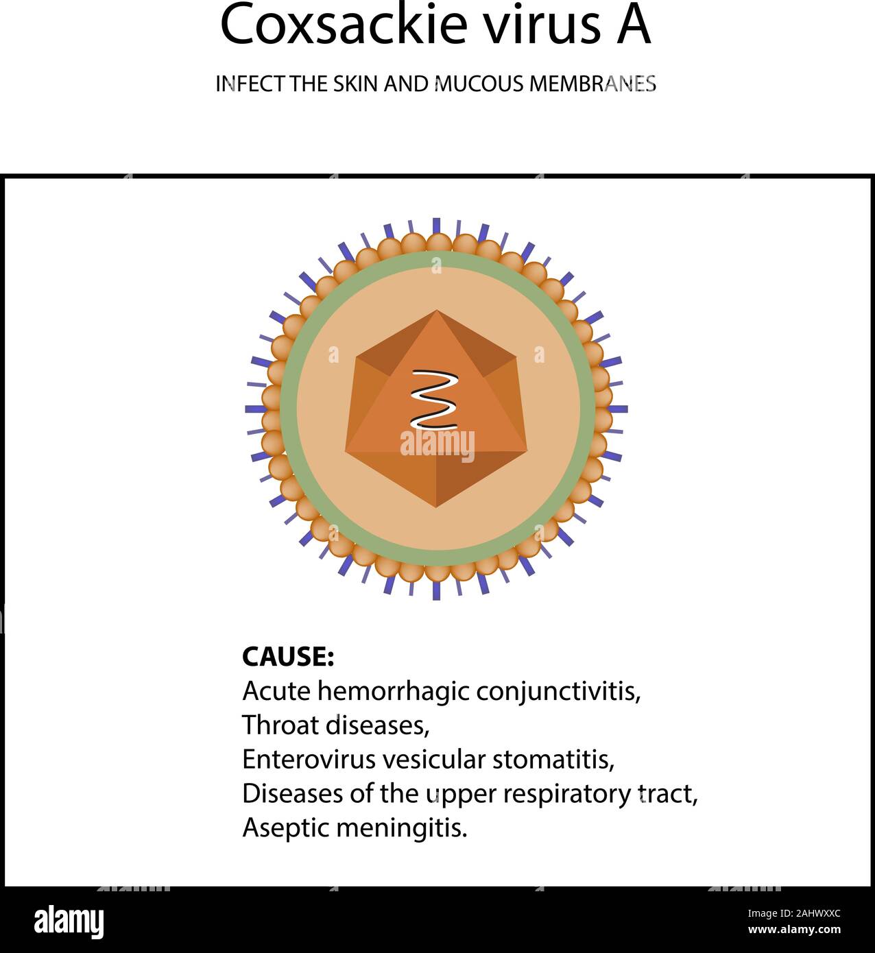 Die Struktur der Coxsackie Virus A Symptome der Krankheit. Enteroviren. Infografiken. Vector Illustration auf isolierte Hintergrund Stock Vektor