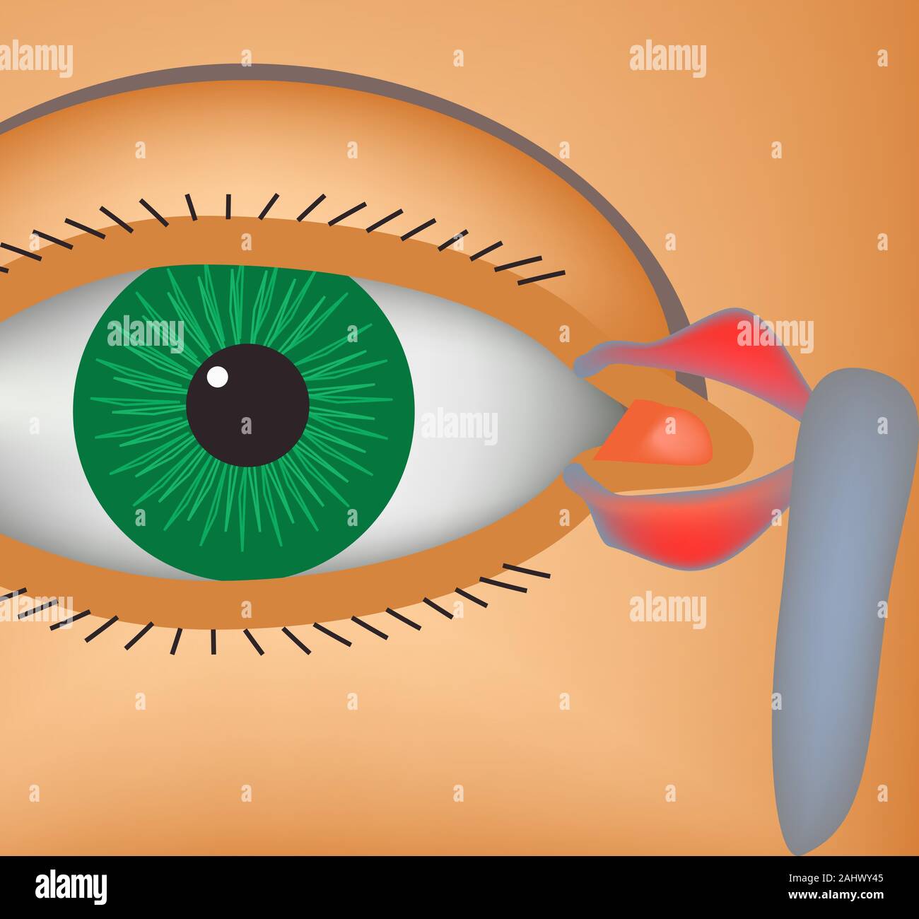 Canaliculitis. Entzündung der lacrimal Kanäle. Die Struktur des Auges. Infografiken. Vector Illustration. Stock Vektor